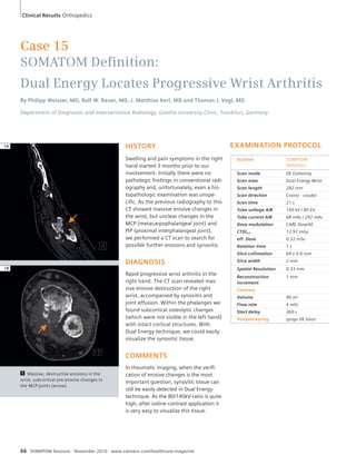 Case 15 
SOMATOM Defi nition: 
Dual Energy Locates Progressive Wrist Arthritis 
By Philipp Weisser, MD, Ralf W. Bauer, MD, J. Matthias Kerl, MD and Thomas J. Vogl, MD 
Department of Diagnostic and Interventional Radiology, Goethe University Clinic, Frankfurt, Germany 
1 Massive, destructive erosions in the 
wrist, subcortical pre-erosive changes in 
the MCP-joints (arrow). 
HISTORY 
Swelling and pain symptoms in the right 
hand started 3 months prior to our 
involvement. Initially there were no 
pathologic findings in conventional radi-ography 
and, unfortunately, even a his-topathologic 
examination was unspe-cific. 
As the previous radiography to this 
CT showed massive erosive changes in 
the wrist, but unclear changes in the 
MCP (metacarpophalangeal joint) and 
PIP (proximal interphalangeal joint), 
we performed a CT scan to search for 
possible further erosions and synovitis. 
DIAGNOSIS 
Rapid progressive wrist arthritis in the 
right hand. The CT scan revealed mas-sive 
erosive destruction of the right 
wrist, accompanied by synovitis and 
joint effusion. Within the phalanges we 
found subcortical osteolytic changes 
(which were not visible in the left hand) 
with intact cortical structures. With 
Dual Energy technique, we could easily 
visualize the synovitic tissue. 
COMMENTS 
In rheumatic imaging, when the verifi-cation 
of erosive changes is the most 
important question, synovitic tissue can 
still be easily detected in Dual Energy 
technique. As the 80/140kV-ratio is quite 
high, after iodine contrast application it 
is very easy to visualize this tissue. 
66 SOMATOM Sessions · November 2010 · www.siemens.com/healthcare-magazine 
1A 
1B 
EXAMINATION PROTOCOL 
Scanner SOMATOM 
Definition 
Scan mode DE Extremity 
Scan area Dual Energy Wrist 
Scan length 282 mm 
Scan direction Cranio - caudal 
Scan time 21 s 
Tube voltage A/B 140 kV / 80 kV 
Tube current A/B 68 mAs / 292 mAs 
Dose modulation CARE Dose4D 
CTDIvol 12.97 mGy 
eff. Dose 0.32 mSv 
Rotation time 1 s 
Slice collimation 64 x 0.6 mm 
Slice width 2 mm 
Spatial Resolution 0.33 mm 
Reconstruction 
1 mm 
increment 
Contrast 
Volume 90 ml 
Flow rate 4 ml/s 
Start delay 360 s 
Postprocessing syngo DE Gout 
Clinical Results Orthopedics 
 