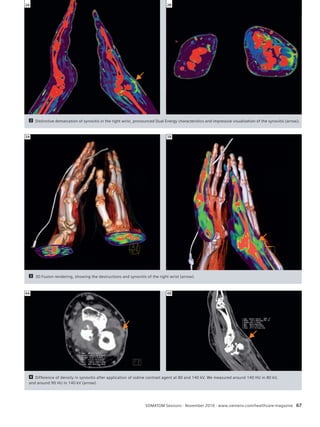 Acute Care Clinical Re Tsoupltics 
2A 2B 
2 Distinctive demarcation of synovitis in the right wrist, pronounced Dual Energy characteristics and impressive visualization of the synovitis (arrow). 
3A 3B 
3 3D Fusion rendering, showing the destructions and synovitis of the right wrist (arrow). 
4A 4B 
4 Difference of density in synovitis after application of iodine contrast agent at 80 and 140 kV. We measured around 140 HU in 80 kV, 
and around 90 HU in 140 kV (arrow). 
SOMATOM Sessions · November 2010 · www.siemens.com/healthcare-magazine 67 
 