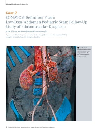 Case 2 
SOMATOM Defi nition Flash: 
Low-Dose Abdomen Pediatric Scan: Follow-Up 
Study of Fibromuscular Dysplasia 
By Pia Säfström, MD, Nils Dahlström, MD and Petter Quick 
Department of Radiology and Center for Medical Image Science and Visualization (CMIV), 
Linköping University Hospital, Linköping, Sweden 
1 
40 SOMATOM Sessions · November 2010 · www.siemens.com/healthcare-magazine 
1 Fused volume-rendered 
view showed 
variant vascular anat-omy 
consisting of 
the common hepatic 
artery (arrow). 
Clinical Results Cardio-Vascular 
 