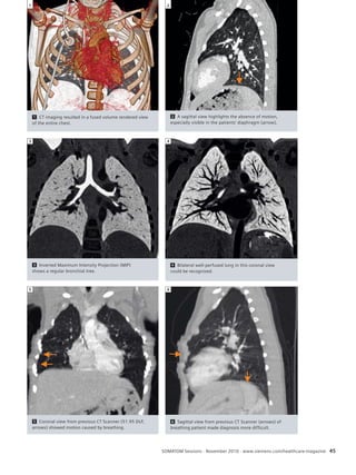 SOMATOM Sessions · November 2010 · www.siemens.com/healthcare-magazine 45 
5 Coronal view from previous CT Scanner (51.95 DLP, 
arrows) showed motion caused by breathing. 
1 
5 
6 Sagittal view from previous CT Scanner (arrows) of 
breathing patient made diagnosis more difficult. 
6 
3 Inverted Maximum Intensity Projection (MIP) 
shows a regular bronchial tree. 
3 
4 Bilateral well-perfused lung in this coronal view 
could be recognized. 
4 
1 CT imaging resulted in a fused volume rendered view 
of the entire chest. 
1 
2 A sagittal view highlights the absence of motion, 
especially visible in the patients’ diaphragm (arrow). 
2 
 