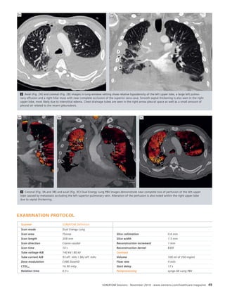 2A 2B 
2 Axial (Fig. 2A) and coronal (Fig. 2B) images in lung window setting show relative hypodensity of the left upper lobe, a large left pulmo-nary 
effusion and a right hilar mass with near complete occlusion of the superior vena cava. Smooth septal thickening is also seen in the right 
upper lobe, most likely due to interstitial edema. Chest drainage tubes are seen in the right arrow pleural space as well as a small amount of 
pleural air related to the recent pleurodesis. 
3A 3B 3C 
3 Coronal (Fig. 3A and 3B) and axial (Fig. 3C) Dual Energy Lung PBV images demonstrate near complete loss of perfusion of the left upper 
lobe caused by metastasis occluding the left superior pulmonary vein. Alteration of the perfusion is also noted within the right upper lobe 
due to septal thickening. 
SOMATOM Sessions · November 2010 · www.siemens.com/healthcare-magazine 49 
EXAMINATION PROTOCOL 
Scanner SOMATOM Definition 
Scan mode Dual Energy Lung 
Scan area Thorax Slice collimation 0.6 mm 
Scan length 308 mm Slice width 1.5 mm 
Scan direction Cranio-caudal Reconstruction increment 1 mm 
Scan time 10 s Reconstruction kernel B30f 
Tube voltage A/B 140 kV / 80 kV Contrast 
Tube current A/B 93 eff. mAs / 382 eff. mAs Volume 100 ml of 350 mg/ml 
Dose modulation CARE Dose4D Flow rate 4 ml/s 
CTDIvol 16.90 mGy Start delay 17 s 
Rotation time 0.5 s Postprocessing syngo DE Lung PBV 
 