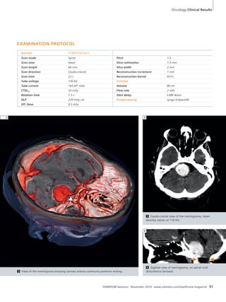 2 View of the meningioma showing (arrow) arteria communis posterior exiting. 
3 Caudo-cranial view of the meningioma, mean 
densitiy values of 110 HU. 
4 Sagittal view of meningioma, no spinal cord 
disturbance (arrows). 
SOMATOM Sessions · November 2010 · www.siemens.com/healthcare-magazine 51 
EXAMINATION PROTOCOL 
Scanner SOMATOM Spirit 
Scan mode Spiral Pitch 1.5 
Scan area Head Slice collimation 1.5 mm 
Scan length 66 mm Slice width 2 mm 
Scan direction Caudo-cranial Reconstruction increment 1 mm 
Scan time 22 s Reconstruction kernel H31s 
Tube voltage 130 kV Contrast 
Tube current 165 eff. mAs Volume 80 ml 
CTDIvol 33 mGy Flow rate 2 ml/s 
Rotation time 1.5 s Start delay CARE Bolus 
DLP 239 mGy cm Postprocessing syngo InSpace4D 
Eff. Dose 0.5 mSv 
2 3 
4 
Oncology Clinical Results 
 