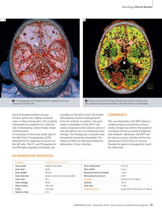 Neurology Clinical Results 
3 Fusion of CTA and TTP delay indicate the occlusion (arrow) and 
the corresponding perfusion delay in the PCA-territory (arrowhead). 
2 3 
via the (also in the CTA visible) 
2 CT-angiography (CTA) detected the P1-segment occlusion 
(arrow) on the left side. 
left posterior communicating branch 
from the anterior circulation. The para-meter 
constellation of the VPCT indi-cated 
a large penumbra volume and so it 
was decided to start an intravenous lysis 
therapy. The therapy was successful and 
the patient recovered remarkably. The 
follow-up NECT on next day showed no 
delineation of any infarction. 
COMMENTS 
This case illustrates, that VPCT allows a 
reliable analysis concerning ischemic 
stroke changes also within the posterior 
circulation territory including thalamus 
and midbrain. Moreover, the VPCT can 
be used as a quick, feasible tool for the 
assessment of the tissue at risk and 
thereby the patient management could 
be influenced. 
SOMATOM Sessions · November 2010 · www.siemens.com/healthcare-magazine 55 
ment of the permeability was per-formed, 
which was slightly increased 
only in a few cortical parts. This could be 
interpreted as a predictor of a reduced 
risk of developing a hemorrhagic stroke 
transformation. 
In correlation to the early stroke sign of 
the NECT the CT-angiography (CTA) 
detected the P1-segement occlusion on 
the left side. The P2- and P3-segment of 
the PCA were regularly contrasted, pre-sumably 
EXAMINATION PROTOCOL 
Scanner SOMATOM Definition AS+ 
Scan mode Adaptive 4D Spiral Slice collimation 0.6 mm 
Scan area Head Slice width 3 mm 
Scan length 96 mm Reconstruction increment 1 mm 
Scan direction Caudo-cranial and cranio-caudal Reconstruction kernel H20f 
Scan time 46 s Contrast Ultravist® 370 mg/ml 
Tube voltage 80 kV Volume 30 ml 
Tube current 200 mAs Flow rate 5 ml/s 
CTDIvol 218 mGy Postprocessing syngo Volume Perfusion CT Neuro 
Rotation time 0.3 s 
 