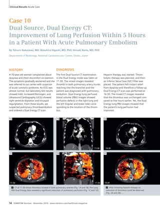 Case 10 
Dual Source, Dual Energy CT: 
Improvement of Lung Perfusion Within 5 Hours 
in a Patient With Acute Pulmonary Embolism 
By Tetsuro Nakazawa, MD; Masahiro Higashi, MD, PhD; Hiroaki Naito, MD, PhD 
Department of Radiology, National Cardiovascular Center, Osaka, Japan 
HISTORY 
A 70-year-old woman complained about 
dyspnea and chest discomfort on exertion. 
The symptoms gradually worsened and she 
was referred to our center with suspicion 
of acute coronary syndrome. An ECG was 
almost normal, but laboratory test results 
showed mild, increased fibrinogen, and 
Ultrasound Cardiography (UCG) showed 
right ventricle dilatation and tricuspid 
regurgitation. From these results, we 
suspected pulmonary thromboembolism 
and ordered a Dual Energy CT scan. 
DIAGNOSIS 
The first Dual Source CT examination 
in the Dual Energy mode was taken at 
11:30. The mixed images revealed 
thrombi in both pulmonary artery trunks 
reaching into the branches and the 
patient was diagnosed with pulmonary 
embolism. Dual Energy lung perfused 
blood volume (PBV) images showed 
perfusion defects in the right lung and 
the left lingular and lower lobe corre-sponding 
to the location of the throm-bus. 
11:30 16:30 
1 CT at 11:30 shows thrombus located in both pulmonary arteries (Fig. 1A and 1B).The Lung 
PBV Dual Energy data revealed a significant reduction of pulmonary perfusion (Fig. 1C and 1D). 
56 SOMATOM Sessions · November 2010 · www.siemens.com/healthcare-magazine 
Heparin therapy was started. Throm-bolytic 
therapy was planned, and then 
an Inferior Vena Cava (IVC) filter was 
placed. The patient felt instant relief 
from dyspnea and therefore a follow-up 
Dual Energy CT scan was performed at 
16:30. The mixed CT images revealed 
that the thrombus was unchanged com-pared 
to five hours earlier. Yet, the Dual 
Energy lung PBV images showed that 
the patient’s lung perfusion had 
improved. 
2 After initiating heparin therapy no 
reduction of thrombus could be observed 
(Fig. 2A and 2B), … 
1A 1B 
1C 1D 
2A 
2C 
11:30 
11:30 11:30 
16:30 
Clinical Results Acute Care 
 