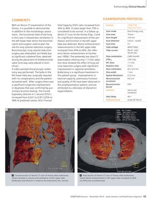 Pulmonology Clinical Results 
4 Axial section of Xenon CT scan of thorax after bullectomy 
shows Xenon enhancement in left upper lobe increased to 64%. 
(vs.44% prior to bullectomy) 
3 4 
SOMATOM Sessions · November 2010 · www.siemens.com/healthcare-magazine 65 
COMMENTS 
With an Xenon CT examination of the 
thorax, it is possible to demonstrate, 
in addition to the morphologic assess-ment, 
the functional state of the lung. 
In this case it showed less ventilation in 
the left lower lobe which the bronchos-copist 
and surgeon used to plan the 
site for lung volume reduction surgery. 
Bronchoscopic lung volume reduction 
surgery was attempted, but failed due 
to significant collateral flow, detected 
during the placement of endobronchial 
valve (one-way valve placed in bron-chius). 
A video-assisted thoracoscopic bullec-tomy 
was performed. The bulla in the 
left lower lobe was surgically resected 
with no complications and the patient 
recovered well. After surgery there was 
a significant subjective improvement 
in dyspnoea that was confirmed by pul-monary 
function testing. The Forced 
Expiratory Volume in 1 second (FEV1) 
increased from 0.62 l to 0.87 l (25% to 
38% of predicted value); FEV1/ Forced 
Vital Capacity (FVC) ratio increased from 
36% to 40%. A value larger than 75% is 
considered to be normal. In a follow up 
Xenon CT scan of the thorax (Figs. 3 and 
4) a significant improvement of the ven-tilation 
and function in the left upper 
lobe was detected. Xenon enhancement 
measurements in the left upper lobe 
increased from 44% to 64%. (for refer-ence 
Xenon enhancement at trachea 
was 100%). The extremely low dose CT 
examination utilizing only 1.7 mSv radia-tion 
dose showed the effect of lung vol-ume 
reduction surgery with significant 
improvement in regional ventilation. 
Bullectomy is a significant treatment in 
this patient group. Improvements in 
exercise capacity, pulmonary function 
and quality of life have been observed in 
this emphysematous patient, and are 
attributed to a decrease of (dynamic) 
hyperinflation. 
3 Coronal section of Xenon CT scan of thorax after bullectomy 
shows increase in volume and ventilation of left upper lobe. 
Atelectasis and effusion is noted at the bullectomy site. (arrow) 
EXAMINATION PROTOCOL 
Scanner SOMATOM 
Definition Flash 
Scan mode Dual Energy Lung 
Scan area Thorax 
Scan length 310 mm 
Scan direction Cranio - caudal 
Scan time 9 s 
Tube voltage 80kV/140kV 
Tube current 80 eff. mAs/ 
48 eff.mAs 
Dose modulation CARE Dose4D 
CTDIvol 3.82 mGy 
Eff. Dose 1.7 mSv 
Rotation time 0.26 s 
Slice collimation 64 x 0.6 mm 
Slice width 1 mm 
Spatial Resolution 0.33 mm 
Reconstruction 
0.8 mm 
increment 
Reconstruction 
Kernel 
D30 
Contrast Xenon gas 
inhalation 
Start delay 90 s 
Postprocessing syngo DE Xenon 
 