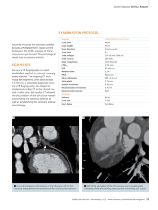 Cardio-Vascular Clinical Results 
EXAMINATION PROTOCOL 
Scanner SOMATOM Definition Flash 
Scan area Heart 
Scan length 17 cm 
Scan direction Cranio-caudal 
Scan time 8 s 
Tube voltage 100 kV with CARE kV 
Tube current 280 mAs 
Dose modulation CARE Dose4D 
CTDIvol 5.90 mGy 
DLP 81 mGy cm 
Rotation time 0.28 s 
Pitch Sequence 
Slice collimation 128 x 0.6 mm 
Slice width 0.75 mm 
Spatial resolution 0.33 mm 
Reconstruction increment 0.4 mm 
Reconstruction kernel B26f 
Contrast 
Volume 80 ml 
Flow rate 5 ml/s 
Start delay Test Bolus 
3 4 
3 Curved multiplanar reformations of the bifurcation of the left 
coronary artery demonstrate enclosure of the coronary artery (arrow). 
4 MIP of the bifurcation of the left coronary artery visualizing the 
narrowing of the left coronary artery and the surrounding soft tissues. 
SOMATOM Sessions · November 2011 · www.siemens.com/healthcare-magazine 35 
not only enclosed the coronary arteries 
but also infiltrated them. Based on the 
findings in the cCTA, a biopsy of these 
masses was performed. The pathological 
result was a coronary arteritis. 
COMMENTS 
Coronary CT Angiography is a well-established 
method to rule out coronary 
artery disease. The ongoing CT tech-nique 
development, with doses below 
1.5 mSv for a complete diagnostic coro-nary 
CT Angiography, has helped to 
implement cardiac CT in the clinical rou-tine. 
In this case, the cardiac CT allowed 
the visualization of the soft tissue masses 
surrounding the coronary arteries as 
well as establishing the coronary arterial 
morphology. 
 