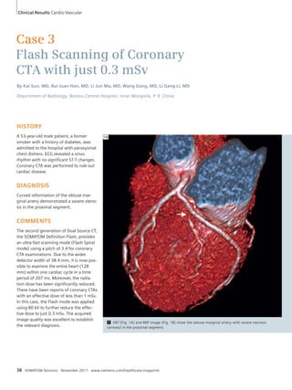 Clinical Results Cardio-Vascular 
Case 3 
Flash Scanning of Coronary 
CTA with just 0.3 mSv 
By Kai Sun, MD, Rui Juan Han, MD, Li Jun Ma, MD, Wang Gang, MD, Li Gang Li, MD 
Department of Radiology, Baotou Central Hospital, Inner Mongolia, P. R. China 
HISTORY 
A 53-year-old male patient, a former 
smoker with a history of diabetes, was 
admitted to the hospital with paroxysmal 
chest distress. ECG revealed a sinus 
rhythm with no significant ST-T changes. 
Coronary CTA was performed to rule out 
cardiac disease. 
DIAGNOSIS 
Curved reformation of the obtuse mar-ginal 
artery demonstrated a severe steno-sis 
in the proximal segment. 
COMMENTS 
The second generation of Dual Source CT, 
the SOMATOM Definition Flash, provides 
an ultra-fast scanning mode (Flash Spiral 
mode) using a pitch of 3.4 for coronary 
CTA examinations. Due to the wider 
detector width of 38.4 mm, it is now pos-sible 
to examine the entire heart (128 
mm) within one cardiac cycle in a time 
period of 207 ms. Moreover, the radia-tion 
dose has been significantly reduced. 
There have been reports of coronary CTAs 
with an effective dose of less than 1 mSv. 
In this case, the Flash mode was applied 
using 80 kV to further reduce the effec-tive 
dose to just 0.3 mSv. The acquired 
image quality was excellent to establish 
the relevant diagnosis. 
1A 
1 VRT (Fig. 1A) and MIP image (Fig. 1B) show the obtuse marginal artery with severe stenosis 
(arrows) in the proximal segment. 
38 SOMATOM Sessions · November 2011 · www.siemens.com/healthcare-magazine 
 