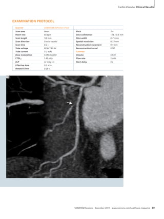 Cardio-Vascular Clinical Results 
SOMATOM Sessions · November 2011 · www.siemens.com/healthcare-magazine 39 
EXAMINATION PROTOCOL 
Scanner SOMATOM Definition Flash 
Scan area Heart Pitch 3.4 
Heart rate 60 bpm Slice collimation 128 x 0.6 mm 
Scan length 128 mm Slice width 0.75 mm 
Scan direction Cranio-caudal Spatial resolution 0.33 mm 
Scan time 0.2 s Reconstruction increment 0.4 mm 
Tube voltage 80 kV / 80 kV Reconstruction kernel B26f 
Tube current 312 mAs Contrast 
Dose modulation CARE Dose4D Volume 60 ml 
CTDIvol 1.43 mGy Flow rate 5 ml/s 
DLP 22 mGy cm Start delay 8 s 
Effective dose 0.3 mSv 
Rotation time 0.28 s 
1B 
 