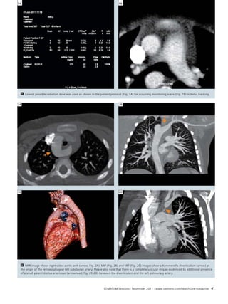 1A 1B 
1 Lowest possible radiation dose was used as shown in the patient protocol (Fig. 1A) for acquiring monitoring scans (Fig. 1B) in bolus tracking. 
2 MPR image shows right-sided aortic arch (arrow, Fig. 2A). MIP (Fig. 2B) and VRT (Fig. 2C) images show a Kommerell‘s diverticulum (arrow) at 
the origin of the retroesophageal left subclavian artery. Please also note that there is a complete vascular ring as evidenced by additional presence 
of a small patent ductus arteriosus (arrowhead, Fig. 2C-2D) between the diverticulum and the left pulmonary artery. 
SOMATOM Sessions · November 2011 · www.siemens.com/healthcare-magazine 41 
2A 
2C 
2B 
2D 
 
