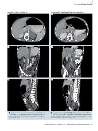 Oncology Clinical Results 
Baseline CT Scan (Vendor A) Follow-up CT Scan (SOMATOM Defi nition Flash) 
1 Images acquired on a scanner from “Vendor A” with a DLP of 
212 mGy cm. Fig. 1A demonstrated a left-sided supra-renal soft 
tissue mass, Figs. 1B and 1C were reconstructed for comparison 
with Figs. 2B and 2C. 
2 Images acquired on the SOMATOM Definition Flash with a DLP of 
33 mGy cm. Figs. 2B and 2C revealed soft tissue masses in the retroperi-toneum 
displacing and compressing the inferior vena cava. Fig. 2A was 
reconstructed for comparison with Fig. 1A. 
SOMATOM Sessions · November 2011 · www.siemens.com/healthcare-magazine 45 
1A 
1B 
1C 
2A 
2B 
2C 
 
