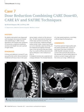 Clinical Results Oncology 
Case 7 
Dose Reduction Combining CARE Dose4D, 
CARE kV and SAFIRE Techniques 
By Richard Deignan, MD, Liz D’Arcy, DCR 
CT Department, Wexford General Hospital, Wexford, Ireland 
HISTORY 
An elderly male patient was diagnosed 
with laryngeal carcinoma and treated 
with radiotherapy in 2002. He was 
admitted to the hospital with symptoms 
of hoarseness, progressive dysphasia, 
anorexia and weight loss over a period 
of eight weeks. 
DIAGNOSIS 
A thorax and abdomen contrast CT scan 
was performed, which demonstrated an 
ill-defined soft tissue mass in the supra- 
sternal region, anterior to the sternum 
(Fig. 1A) with asymmetrical thickening 
of the major pectoral muscle (Fig. 1B). 
In the clinical exam, bilateral enlarged 
axillary lymph nodes, measuring as large 
as 3 cm in diameter, were found (Fig. 2). 
An ill-defined and slightly enhanced 
mass in the sub-carinal area was shown 
(Fig. 3), as well as diffuse abnormal soft 
tissue infiltration in the mediastinum 
(Fig. 4). 
A malignant process was suspected and 
a biopsy followed. This showed features 
1A 1B 
46 SOMATOM Sessions · November 2011 · www.siemens.com/healthcare-magazine 
of a high grade lymphoma, most likely 
a diffuse large B-cell lymphoma. 
COMMENTS 
To achieve optimal image quality with 
the lowest possible dose, various CT 
techniques have been established. 
CARE Dose4D modulates the tube 
current (mA) automatically based on 
the diameter of various body regions to 
produce constant image quality over 
the entire scan range. CARE kV uses 
1 Sagittal MPR demonstrates an ill-defined soft tissue mass in the supra sternal region, anterior to the sternum (Fig. 1A). 
Axial image shows asymmetrical thickening of the major pectoral muscle (Fig. 1B). 
 