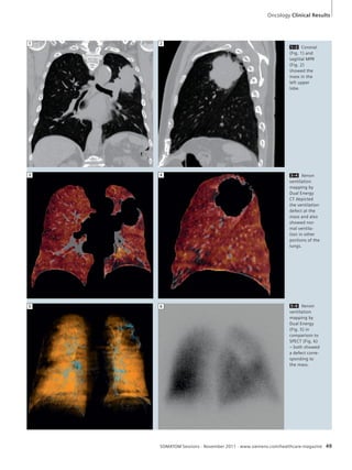 Oncology Clinical Results 
1–2 Coronal 
(Fig. 1) and 
sagittal MPR 
(Fig. 2) 
showed the 
mass in the 
left upper 
lobe. 
3–4 Xenon 
ventilation 
mapping by 
Dual Energy 
CT depicted 
the ventilation 
defect at the 
mass and also 
showed nor-mal 
ventila-tion 
in other 
portions of the 
lungs. 
5–6 Xenon 
ventilation 
mapping by 
Dual Energy 
(Fig. 5) in 
comparison to 
SPECT (Fig. 6) 
– both showed 
a defect corre-sponding 
to 
the mass. 
1 2 
3 4 
5 6 
SOMATOM Sessions · November 2011 · www.siemens.com/healthcare-magazine 49 
 