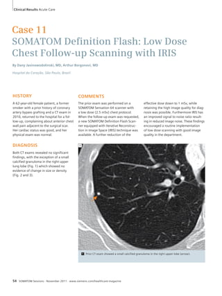 Clinical Results Acute Care 
Case 11 
SOMATOM Defi nition Flash: Low Dose 
Chest Follow-up Scanning with IRIS 
By Dany Jasinowodolinski, MD, Arthur Borgonovi, MD 
Hospital do Coração, São Paulo, Brazil 
HISTORY 
A 62-year-old female patient, a former 
smoker with a prior history of coronary 
artery bypass grafting and a CT exam in 
2010, returned to the hospital for a fol-low- 
up, complaining about anterior chest 
wall pain adjacent to the surgical scar. 
Her cardiac status was good, and her 
physical exam was normal. 
DIAGNOSIS 
Both CT exams revealed no significant 
findings, with the exception of a small 
calcified granuloma in the right upper 
lung lobe (Fig. 1) which showed no 
evidence of change in size or density 
(Fig. 2 and 3). 
COMMENTS 
The prior exam was performed on a 
SOMATOM Sensation 64 scanner with 
a low dose (2.5 mSv) chest protocol. 
When the follow-up exam was requested, 
a new SOMATOM Definition Flash Scan-ner 
equipped with Iterative Reconstruc-tion 
in Image Space (IRIS) technique was 
available. A further reduction of the 
effective dose down to 1 mSv, while 
retaining the high image quality for diag-nosis 
was possible. Furthermore IRIS has 
an improved signal to noise ratio result-ing 
in reduced image noise. These findings 
encouraged a routine implementation 
of low dose scanning with good image 
quality in the department. 
1 Prior CT exam showed a small calcified granuloma in the right upper lobe (arrow). 
1 
54 SOMATOM Sessions · November 2011 · www.siemens.com/healthcare-magazine 
 