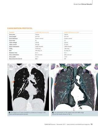 Acute Care Clinical Results 
SOMATOM Sessions · November 2011 · www.siemens.com/healthcare-magazine 55 
EXAMINATION PROTOCOL 
Scanner SOMATOM Sensation 64 SOMATOM Definition Flash 
Scan area Thorax Thorax 
Scan length 351 mm 351 mm 
Scan direction Caudo-cranial Caudo-cranial 
Scan time 6 s 3 s 
Tube voltage 120 kV 120 kV 
Tube current 58 mAs 27 mAs 
Dose modulation CARE Dose4D CARE Dose4D 
CTDIvol 4.44 mGy 1.86 mGy 
DLP 176 mGy cm 72 mGy cm 
Rotation time 0.5 s 0.5 s 
Slice collimation 64 x 0.6 mm 128 x 0.6 mm 
Slice width 3 mm 1 mm 
Reconstruction kernel B60 I50 
2 The follow-up CT exam revealed no evidence of change in the 
small calcified granuloma (arrow). 
3 The presentation of 3D image fused with MPR image 
affirms the results shown in Fig. 2. 
2 3 
 