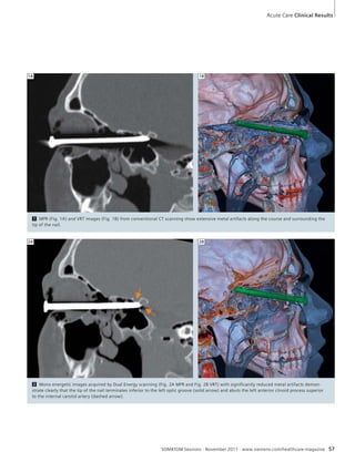 Acute Care Clinical Results 
1A 1B 
1 MPR (Fig. 1A) and VRT images (Fig. 1B) from conventional CT scanning show extensive metal artifacts along the course and surrounding the 
tip of the nail. 
2A 2B 
2 Mono energetic images acquired by Dual Energy scanning (Fig. 2A MPR and Fig. 2B VRT) with significantly reduced metal artifacts demon-strate 
clearly that the tip of the nail terminates inferior to the left optic groove (solid arrow) and abuts the left anterior clinoid process superior 
SOMATOM Sessions · November 2011 · www.siemens.com/healthcare-magazine 57 
to the internal carotid artery (dashed arrow). 
 