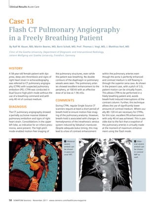 Clinical Results Acute Care 
Case 13 
Flash CT Pulmonary Angiography 
in a Freely Breathing Patient 
By Ralf W. Bauer, MD, Martin Beeres, MD, Boris Schell, MD, Prof. Thomas J. Vogl, MD, J. Matthias Kerl, MD 
Clinic of the Goethe University, Department of Diagnostic and Interventional Radiology, 
Johann Wolfgang von Goethe University, Frankfurt, Germany 
HISTORY 
A 58-year-old female patient with dys-pnea, 
deep vein thrombosis and signs of 
right heart strain in echocardiography, 
was referred to CT pulmonary angiogra-phy 
(CTPA) with suspected pulmonary 
embolism (PE). CTPA was conducted in 
Dual Source high-pitch mode without the 
use of a breathing command and with 
only 40 ml of contrast medium. 
DIAGNOSIS 
The CT pulmonary angiography showed 
a partially occlusive massive bilateral 
pulmonary embolism and signs of right 
heart strain. Consolidations in the upper 
left lobe, as indicative for an infarct pneu-monia, 
were present. The high-pitch 
mode enabled motion-free imaging of 
the pulmonary structures, even while 
the patient was breathing. No double 
contours of the diaphragm or pulmonary 
vessels were seen. The pulmonary arter-ies 
showed excellent enhancement to the 
periphery, at 100 kV with an effective 
dose of as low as 1.96 mSv. 
COMMENTS 
During CTPA, regular Single Source CT 
scanners require at least a short period of 
breath-hold to ensure motion-free imag-ing 
of the pulmonary anatomy. However, 
breath-hold is associated with changes in 
hemodynamics of the intrathoracic venous 
system induced by Valsalva’s maneuver. 
Despite adequate bolus timing, this may 
lead to a loss of contrast enhancement 
within the pulmonary arteries even 
though the aorta is perfectly enhanced 
and contrast medium is still flowing in 
through the superior vena cava. As shown 
in the present case, with a pitch of 3.0, 
patient motion can be virtually frozen. 
This allows CTPA to be performed in a 
freely breathing patient and, avoids 
breath-hold induced interruptions of the 
contrast column. Further, this technique 
allows the use of significantly lower 
amounts of contrast medium. Where usu-ally 
80–120 ml are necessary for CTPAs, 
for this scan, excellent PA enhancement 
with only 40 ml was achieved. This is pos-sible 
due to the fact that a snapshot of 
the pulmonary arteries is virtually made 
at the moment of maximum enhance-ment 
using the Flash mode. 
1 Bilateral 
severe 
emboli can 
be shown 
in para-cor-onal 
VRT. 
58 SOMATOM Sessions · November 2011 · www.siemens.com/healthcare-magazine 
2 Bilat-eral 
severe 
emboli can 
be shown 
in coronal 
MIP as 
well. 
1 2 
 