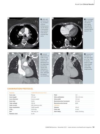 Acute Care Clinical Results 
4 An enlarged 
right ventricle 
and atrium 
with clearly 
definable AV 
valves can be 
revealed (RV/LV 
ratio of 1.2). 
3 4 
5 6 
SOMATOM Sessions · November 2011 · www.siemens.com/healthcare-magazine 59 
2A 
3 With opti-mal 
bolus tim-ing, 
excellent 
contrast 
enhancement 
can be shown 
in the pulmo-nary 
arteries: 
note almost 
contrast-free 
aorta. 
6 Coronal ref-ormation 
at 
the same level 
as in Fig. 5 but 
in venous 
phase in inspi-ratory 
breath 
hold: Note 
comparable 
image quality. 
5 Coronal 
reformation of 
CTPA in lung 
window: note 
motion-free 
delineation of 
the diaphragm, 
pulmonary 
vessels and 
infarction in 
the left upper 
lobe, although 
the patient 
was breathing. 
E XAMINATION PROTOCOL 
Scanner SOMATOM Definition Flash 
Scan area Thorax Pitch 3.0 
Scan length 273 mm Slice collimation 128 x 0.6 mm 
Scan direction Cranio-caudal Slice width 1.0 mm 
Scan time 0.68 s Reconstruction increment 0.5 mm 
Tube voltage 100 kV Reconstruction kernel B26f 
Tube current 180 reference mAs Contrast 
Dose modulation CARE Dose4D Volume 40 ml 
CTDIvol 4.06 mGy Flow rate 4 ml/s 
DLP 140 mGy cm Start delay bolus tracking 
Rotation time 0.28 s 
 