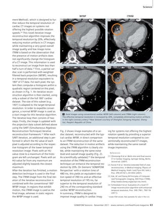 Science 
WFBP iTRIM 
2 Axial images using conventional cardiac WFBP (left column) and iTRIM (right column). 
The effective temporal resolution is increased by 20%, completely eliminating motion artifacts 
in the right coronary artery.[4] Raw dataset courtesy of Shanghai Jiangong Hospital, Shang-hai, 
SOMATOM Sessions · November 2011 · www.siemens.com/healthcare-magazine 63 
ment Method), which is designed to fur-ther 
reduce the temporal resolution of 
cardiac CT images on systems not 
offering the highest possible rotation 
speeds.[4] This novel iterative image 
reconstruction algorithm improves the 
temporal resolution by 20%, effectively 
reducing motion artifacts in CT images 
while maintaining a very good overall 
image quality and low image noise. 
iTRIM is based on the observation that 
the presence of motion artifacts does 
not significantly change the histogram 
of a CT image. This information is used 
to reconstruct an image from less than 
half a turn of data.[2] First, a partial car-diac 
scan is performed with weighted 
filtered back projection (WFBP), resulting 
in a temporal resolution equivalent to 
180º of CT data. For each pixel, the sys-tem 
then computes a histogram within a 
quadratic region centered on the pixel, 
as shown in Fig. 1. An iterative recon-struction 
algorithm is then started, using 
only a subset of the full 180° cardiac 
dataset. The size of this subset (e.g. 
140°) is adapted to the target temporal 
resolution. In order to expedite conver-gence, 
a normal WFBP image is used as 
a start image for this iterative algorithm. 
The iterative loop then consists of two 
steps: Firstly, the image is updated with 
the projection data subset defined above 
using the SART (Simultaneous Algebraic 
Reconstruction Technique) iterative 
reconstruction framework.[3] After each 
SART iteration, an additional step is per-formed 
in which the HU value of each 
pixel is adjusted according to the respec-tive 
histogram of the lower temporal 
resolution image: Pixels with an HU 
value close to a maximum of the histo-gram 
are left unchanged. Pixels with an 
HU value far from any maximum are 
adjusted slightly towards the closest 
maximum. 
After the iteration has finished, a motion 
detection technique is used in the final 
step. The iTRIM image from the final iter-ation 
of the iterative reconstruction is 
combined with the conventional 180º 
WFBP image. In regions that exhibit 
motion, the iTRIM image is used as the 
final image, whereas in static regions 
the WFBP image is used. 
Fig. 2 shows image examples of a car-diac 
dataset, reconstructed with the typ-ical 
cardiac WFBP, in direct comparison 
to an iTRIM reconstruction of the same 
dataset. The reduction in motion artifacts 
using the iTRIM algorithm is clearly visi-ble, 
while maintaining the same noise 
level and overall image quality (Fig. 2). 
As scientifically validated,[4] the temporal 
resolution of the iTRIM reconstruction 
technique can enhance the temporal res-olution 
by 20%. On Siemens’ SOMATOM 
Perspective1 with a rotation time of 
480 ms, this yields an equivalent rota-tion 
speed of 390 ms and an effective 
temporal resolution of 195 ms, far 
superior to the temporal resolution of 
240 ms of the corresponding standard 
cardiac WFBP reconstruction. 
In summary, iTRIM is designed to 
improve image quality in cardiac imag- 
References 
[1] Ohnesorge B et al. Multi-slice and Dual-source 
CT in Cardiac Imaging, Springer Verlag, Berlin, 
second ed. (2007). 
[2] Kunze H et al. Iterative extended field of view 
reconstruction, in Medical Imaging: Physics of 
Medical Imaging, Hsieh J and Flynn M J (eds.), 
Proc. SPIE 6510(1), 65105X (2007). 
[3] Kak, AC and Slaney M Principles of Computer-ized 
Tomographic Imaging, IEEE Press (1998), 
(http://www.slaney.org/pct/pct-toc.html). 
[4] Schöndube H et al. Evaluation of a novel CT 
image reconstruction algorithm with enhanced 
temporal resolution, Proc. SPIE 7961, 79611N 
(2011). 
People’s Republic of China 
ing for systems not offering the highest 
rotation speeds by providing a superior 
temporal resolution compared to con-ventionally 
reconstructed CT images, 
while maintaining the same overall 
image impression. 
2A 
2B 
2C 
2D 
1 Under FDA review. Not available for sale in the U.S. 
 