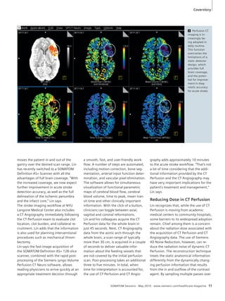 3 Perfusion CT 
imaging is in-creasingly 
be-ing 
adopted in 
daily routine. 
This function 
overcomes the 
limitations of a 
static detector 
design, which 
provides full 
brain coverage, 
and the poten-tial 
for improve-ment 
in diag-nostic 
accuracy 
for acute stroke. 
SOMATOM Sessions · May 2010 · www.siemens.com/healthcare-magazine 11 
3 
Coverstory 
a smooth, fast, and user-friendly work-flow. 
A number of steps are automated, 
including motion correction, bone seg-mentation, 
arterial input function deter-mination, 
and vascular pixel elimination. 
The software allows for simultaneous 
visualization of functional parametric 
maps of cerebral blood flow, cerebral 
blood volume, time to peak, mean tran-sit 
time and other clinically important 
information. With the click of a button, 
clinicians can toggle between axial, 
sagittal and coronal reformations. 
Lin and his colleagues acquire the CT 
Perfusion data for the whole brain in 
just 45 seconds. Next, CT Angiography 
data from the aortic arch through the 
whole brain, a scan range of typically 
more than 30 cm, is acquired in a couple 
of seconds to deliver valuable infor-mation 
about the feeding vessels that 
are not covered by the initial perfusion 
scan. Post-processing takes an additional 
three to five minutes. In total, when 
time for interpretation is accounted for, 
the use of CT Perfusion and CT Angio-moves 
the patient in and out of the 
gantry over the desired scan range. Lin 
has recently switched to a SOMATOM 
Definition AS+ Scanner with all the 
advantages of full brain coverage. “With 
the increased coverage, we now expect 
further improvement in acute stroke 
detection accuracy, as well as the full 
delineation of the ischemic penumbra 
and the infarct core,” Lin says. 
The stroke imaging workflow at NYU 
Langone Medical Center also includes 
a CT Angiography immediately following 
the CT Perfusion exam to evaluate clot 
location, clot burden, and collateral re-cruitment. 
Lin adds that the information 
is also used for planning interventional 
procedures such as mechanical throm-bectomy. 
Lin says the fast image acquisition of 
the SOMATOM Definition AS+ 128-slice 
scanner, combined with the rapid post-processing 
of the Siemens syngo Volume 
Perfusion CT Neuro software, allows 
reading physicians to arrive quickly at an 
appropriate treatment decision through 
graphy adds approximately 10 minutes 
to the acute stroke workflow. “That’s not 
a lot of time considering that the addi-tional 
information provided by the CT 
Perfusion and the CT Angiography may 
have very important implications for the 
patient’s treatment and management,” 
Lin says. 
Reducing Dose in CT Perfusion 
Lin recognizes that, while the use of CT 
Perfusion is moving from academic 
medical centers to community hospitals, 
some barriers to its widespread adoption 
remain. Chief among them is a concern 
about the radiation dose associated with 
the acquisition of CT Perfusion and CT 
Angiography data. The use of Siemens 
4D Noise Reduction, however, can re-duce 
the radiation noise of dynamic CT 
Perfusion. The reconstruction technique 
treats the static anatomical information 
differently from the dynamically chang-ing 
perfusion information that results 
from the in and outflow of the contrast 
agent. By sampling multiple passes over 
 