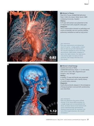 News 
5 Winner in Thorax 
Flash ECG Thorax (SOMATOM Definition 
Flash / 0.82 mSv dose), Petter Quick; CMIV 
Linköping University; Sweden 
History: 
A 47-year-old woman was presented to the 
CT-department with unspecific chest pain. 
Diagnosis: 
The CT examination showed no pathology and 
could successfully rule out coronary disease, 
pulmonary embolism as well as lung tumor. 
Jury statement: 
“This case represented everything that 
chest CT can be – a high quality, volume 
data set that can provide information 
for vascular imaging as well as the lung 
parenchyma. High quality imaging re-quires 
the right scanner, the right proto-cols 
and the right execution of these 
protocols. This image tells that story 
very nicely.” 
6 Winner in Dual Energy 
Carotid and Circle of Willis 
(SOMATOM Definition Flash / 1.12 mSv dose), 
João Carlos Costa, MD, Diagnóstico por 
Imagem, Lda, Portugal 
History: 
A healthy 75-year-old female was presented 
to the CT-department with a family history 
of carotid artery stenosis. 
Diagnosis: 
Small atherosclerotic plaques in the emergence 
of braquiocephalic trunk and left carotid artery 
were identified. 
Jury statement: 
“This case illustrates the power of Dual 
Energy CT for tissue differentiation. In 
a single image and at tremendously low 
doses, all tissue layers in the human body 
can be simultaneously and intuitively 
displayed and provide the anatomic con-text 
of the target structure, the carotid 
circulation.” 
SOMATOM Sessions · May 2010 · www.siemens.com/healthcare-magazine 27 
5 
6 
 