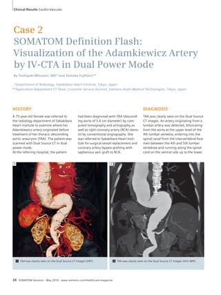 Clinical Results Cardio-Vascular 
Case 2 
SOMATOM Defi nition Flash: 
Visualization of the Adamkiewicz Artery 
by IV-CTA in Dual Power Mode 
By Yoshiyuki Mizutani, MD* and Tomoko Fujihara** 
*Department of Radiology, Sakakibara Heart Institute, Tokyo, Japan 
**Application Department CT Team, Customer Service Division, Siemens-Asahi Medical Technologies, Tokyo, Japan 
HISTORY 
A 75-year-old female was referred to 
the radiology department of Sakakibara 
Heart Institute to examine where her 
Adamkiewicz artery originated before 
treatment of her thoracic descending 
aortic aneurysm (TAA). The patient was 
scanned with Dual Source CT in dual 
power mode. 
At the referring hospital, the patient 
had been diagnosed with TAA (descend-ing 
aorta of 5.6 cm diameter) by com-puted 
tomography and echography as 
well as right coronary artery (RCA) steno-sis 
by conventional angiography. She 
was referred to Sakakibara Heart Insti-tute 
for surgical vessel replacement and 
coronary artery bypass grafting with 
saphenous vein graft to RCA. 
34 SOMATOM Sessions · May 2010 · www.siemens.com/healthcare-magazine 
DIAGNOSIS 
TAA was clearly seen on the Dual Source 
CT images. An artery originating from a 
lumbar artery was detected, bifurcating 
from the aorta at the upper level of the 
4th lumbar vertebra, entering into the 
spinal canal from the intervertebral fora-men 
between the 4th and 5th lumbar 
vertebrae and running along the spinal 
cord on the ventral side up to the lower 
2 
1 TAA was clearly seen on the Dual Source CT images (VRT). 2 TAA was clearly seen on the Dual Source CT images (thin MIP). 
1 
 
