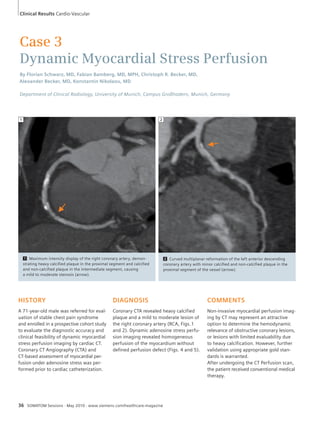 Clinical Results Cardio-Vascular 
Case 3 
Dynamic Myocardial Stress Perfusion 
By Florian Schwarz, MD, Fabian Bamberg, MD, MPH, Christoph R. Becker, MD, 
Alexander Becker, MD, Konstantin Nikolaou, MD 
Department of Clinical Radiology, University of Munich, Campus Großhadern, Munich, Germany 
HISTORY 
A 71-year-old male was referred for eval-uation 
of stable chest pain syndrome 
and enrolled in a prospective cohort study 
to evaluate the diagnostic accuracy and 
clinical feasibility of dynamic myocardial 
stress perfusion imaging by cardiac CT. 
Coronary CT Angiography (CTA) and 
CT-based assessment of myocardial per-fusion 
under adenosine stress was per-formed 
prior to cardiac catheterization. 
DIAGNOSIS 
Coronary CTA revealed heavy calcified 
plaque and a mild to moderate lesion of 
the right coronary artery (RCA, Figs. 1 
and 2). Dynamic adenosine stress perfu-sion 
imaging revealed homogeneous 
perfusion of the myocardium without 
defined perfusion defect (Figs. 4 and 5). 
36 SOMATOM Sessions · May 2010 · www.siemens.com/healthcare-magazine 
COMMENTS 
Non-invasive myocardial perfusion imag-ing 
by CT may represent an attractive 
option to determine the hemodynamic 
relevance of obstructive coronary lesions, 
or lesions with limited evaluability due 
to heavy calcification. However, further 
validation using appropriate gold stan-dards 
is warranted. 
After undergoing the CT Perfusion scan, 
the patient received conventional medical 
therapy. 
1 Maximum intensity display of the right coronary artery, demon-strating 
heavy calcified plaque in the proximal segment and calcified 
and non-calcified plaque in the intermediate segment, causing 
a mild to moderate stenosis (arrow). 
1 
2 Curved multiplanar reformation of the left anterior descending 
coronary artery with minor calcified and non-calcified plaque in the 
proximal segment of the vessel (arrow). 
2 
 