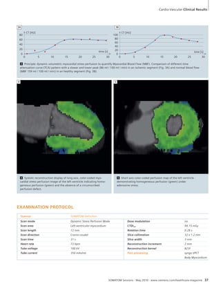 Cardio-Vascular Clinical Results 
time [s] 
CT [HU] 
time [s] 
CT [HU] 
3B 
3 Principle: dynamic volumetric myocardial stress perfusion to quantify Myocardial Blood Flow (MBF). Comparison of different time 
attenuation curve (TCA) pattern with a slower and lower peak (86 ml / 100 ml / min) in an ischemic segment (Fig. 3A) and normal blood flow 
(MBF 159 ml / 100 ml / min) in an healthy segment (Fig. 3B). 
SOMATOM Sessions · May 2010 · www.siemens.com/healthcare-magazine 37 
EXAMINATION PROTOCOL 
Scanner SOMATOM Definition 
Scan mode Dynamic Stress Perfusion Mode Dose modulation no 
Scan area Left ventricular myocardium CTDIvol 94.15 mGy 
Scan length 72 mm Rotation time 0.28 s 
Scan direction Cranio-caudal Slice collimation 32 x 1.2 mm 
Scan time 31 s Slice width 3 mm 
Heart rate 72 bpm Reconstruction increment 2 mm 
Tube voltage 100 kV Reconstruction kernel B23f 
Tube current 350 mAs/rot. Post processing syngo VPCT 
Body Myocardium 
4 Systolic reconstruction display of long axis, color-coded myo-cardial 
stress perfusion image of the left ventricle indicating homo-geneous 
perfusion (green) and the absence of a circumscribed 
perfusion defect. 
4 
5 Short axis color-coded perfusion map of the left ventricle 
demonstrating homogeneous perfusion (green) under 
adenosine stress. 
5 
3A 
80 
60 
40 
20 
0 
0 5 10 15 20 25 30 
100 
80 
60 
40 
20 
0 
0 5 10 15 20 25 30 
 