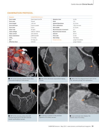 Cardio-Vascular Clinical Results 
3 
5 6 
SOMATOM Sessions · May 2010 · www.siemens.com/healthcare-magazine 39 
EXAMINATION PROTOCOL 
Scanner SOMATOM Definition 
Scan mode Flash Spiral CorCTA Rotation time 0.28 s 
Scan area Thorax Pitch 3.4 
Scan length 130 mm Spatial Resolution 0.33 mm 
Scan direction Cranio-caudal Slice collimation 128 x 0.6 mm 
Scan time 0.28 s Slice width 0.75 mm 
Heart rate 56 bpm Reconstruction increment 0.7 
Tube voltage 100 kV / 100 kV Reconstruction kernel B26f 
Tube current 320 mAs/rot. Volume 60 ml 
Dose modulation CARE Dose4D Flow rate 6 ml/s 
CTDIvol 3.10 mGy Start delay Test Bolus 
DLP 57 mGy cm Postprocessing syngo Circulation 
Effective Dose 0.8 mSv syngo InSpace 
2 
2 MIP of the LAD shows myocardial bridging 
(arrow). 
3 MIP of the first diagonal branch (D1) of the 
LAD, discovers plunge into myocardium. 
1 
1 VRT of the Coronary arteries shows deep 
myocardial bridging of LAD (arrow). 
5 A stenosis is present in the proximal 
segment of CX artery (arrow). 
6 Cross-sectional view displays the 
stenotic area of CX artery. 
4 
4 MIP of the coronary artery tree with 
removed blood pool of the left ventricle 
reveals calcifications (arrow). 
 
