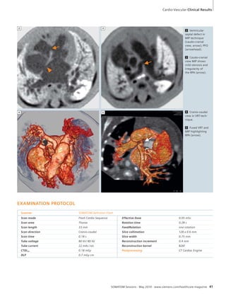 2 3 
Cardio-Vascular Clinical Results 
EXAMINATION PROTOCOL 
2 Ventricular 
septal defect in 
MIP technique 
(caudo-cranial 
view, arrow); PFO 
(arrowhead). 
3 Caudo-cranial 
view MIP shows 
mild stenosis and 
irregularity of 
the RPA (arrow). 
4 Cranio-caudal 
view in VRT-tech-nique. 
5 Fused VRT and 
MIP highlighting 
RPA (arrow). 
Scanner SOMATOM Definition Flash 
Scan mode Flash Cardio Sequence Effective Dose 0.05 mSv 
Scan area Thorax Rotation time 0.28 s 
Scan length 33 mm Feed/Rotation one rotation 
Scan direction Cranio-caudal Slice collimation 128 x 0.6 mm 
Scan time 0.18 s Slice width 0.75 mm 
Tube voltage 80 kV / 80 kV Reconstruction increment 0.4 mm 
Tube current 22 mAs / rot. Reconstruction kernel B26f 
CTDIvol 0.18 mGy Postprocessing CT Cardiac Engine 
DLP 0.7 mGy cm 
4 
SOMATOM Sessions · May 2010 · www.siemens.com/healthcare-magazine 41 
5 
 
