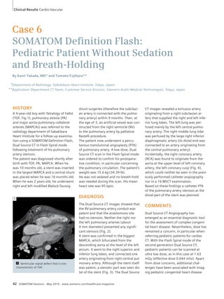 Clinical Results Cardio-Vascular 
Case 6 
SOMATOM Defi nition Flash: 
Pediatric Patient Without Sedation 
and Breath-Holding 
By Kaori Takada, MD* and Tomoko Fujihara** 
Department of Radiology, Sakakibara Heart Institute, Tokyo, Japan 
Application Department CT Team, Customer Service Division, Siemens-Asahi Medical Technologies, Tokyo, Japan 
HISTORY 
A 4-year-old boy with Tetralogy of Fallot 
(TOF, Fig.1), pulmonary atresia (PA) 
and major aorto-pulmonary collateral 
arteries (MAPCAs) was referred to the 
radiology department of Sakakibara 
Heart Institute for a follow-up examina-tion 
using a SOMATOM Definition Flash, 
Dual Source CT in Flash Spiral mode 
following treatment of his pulmonary 
artery stenosis. 
The patient was diagnosed shortly after 
birth with TOF, PA, MAPCA. When he 
was 10 months old, a stent was inserted 
in the largest MAPCA and a central shunt 
was placed when he was 16 months old. 
When he was 2 years old, he underwent 
right and left modified Blalock-Taussig 
42 SOMATOM Sessions · May 2010 · www.siemens.com/healthcare-magazine 
CT images revealed a tortuous artery 
originating from a right subclavian ar-tery 
that supplied the right and left infe-rior 
lung lobes. The left lung was per-fused 
mainly by the left central pulmo-nary 
artery. The right middle lung lobe 
was perfused by the large right inferior 
diaphragmatic artery (its distal end was 
connected to an artery originating from 
the central pulmonary artery). 
Incidentally, the right coronary artery 
(RCA) was found to originate from the 
aorta at the upper level of left coronary 
artery, the left coronary cusp (Fig. 4), 
which could neither be seen in the previ-ously 
performed catheter angiography 
nor in a 16-MSCT examination. 
Based on these findings a catheter PTA 
of the pulmonary artery stenosis at the 
distal part of the stent was planned. 
COMMENTS 
Dual Source CT Angiography has 
emerged as an essential diagnostic tool 
for the assessment of complex congeni-tal 
heart disease. Nevertheless, dose has 
remained a concern, in particular when 
referring pediatric patients for cardiac 
CT. With the Flash Spiral mode of the 
second generation Dual Source CT, 
pediatric patients can be scanned at 
ultra low dose, as in this case at 1.63 
mGy (effective dose 0.644 mSv). Apart 
from dose concerns, additional chal-lenges 
have been associated with imag-ing 
pediatric congenital heart disease 
shunt surgeries (therefore the subclavi-an 
artery is connected with the pulmo-nary 
artery) within 9 months. Then, at 
the age of 3, an artificial vessel was con-structed 
from the right ventricle (RV) 
to the pulmonary artery by palliative 
Rastelli procedure. 
The patient now underwent a percu-tanous 
transluminal angioplasty (PTA) 
of pulmonary artery. A low dose, Dual 
Source CT scan in the Flash Spiral mode 
was ordered to confirm his postopera-tive 
condition, in particular concerning 
the pulmonary circulation. The patient’s 
weight was 15.6 kg (34.39 lb). 
He was not sedated and no breath-hold 
was needed during the scan. His mean 
heart rate was 95 bpm. 
DIAGNOSIS 
The Dual Source CT images showed that 
the RV-pulmonary artery conduit was 
patent and that the anastomosis site 
had no stenosis. Neither the right nor 
the left pulmonary arteries (about 
4 mm diameter) presented any signifi-cant 
stenosis (Fig. 2). 
A stent was confirmed in the biggest 
MAPCA, which bifurcated from the 
descending aorta at the level of the left 
atrium. It went to the right superior and 
inferior lung lobes, and connected one 
artery originating from right central pul-monary 
artery. Although the stent itself 
was patent, a stenotic part was seen dis-tal 
of the stent (Fig. 3). The Dual Source 
1 Ventricular septal defect that is one 
characteristic of TOF. 
1 
* 
** 
 