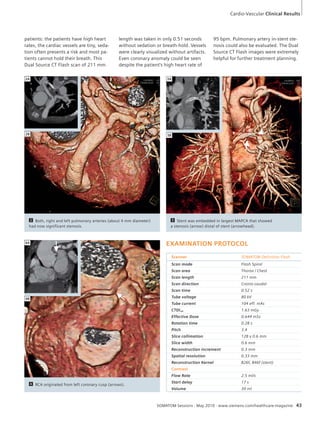 Cardio-Vascular Clinical Results 
2A 3A 
2B 3B 
SOMATOM Sessions · May 2010 · www.siemens.com/healthcare-magazine 43 
2 Both, right and left pulmonary arteries (about 4 mm diameter) 
had now significant stenosis. 
3 Stent was embedded in largest MAPCA that showed 
a stenosis (arrow) distal of stent (arrowhead). 
4 RCA originated from left coronary cusp (arrows). 
4A 
4B 
EXAMINATION PROTOCOL 
Scanner SOMATOM Definition Flash 
Scan mode Flash Spiral 
Scan area Thorax / Chest 
Scan length 211 mm 
Scan direction Cranio-caudal 
Scan time 0.52 s 
Tube voltage 80 kV 
Tube current 104 eff. mAs 
CTDIvol 1.63 mGy 
Effective Dose 0.644 mSv 
Rotation time 0.28 s 
Pitch 3.4 
Slice collimation 128 x 0.6 mm 
Slice width 0.6 mm 
Reconstruction increment 0.3 mm 
Spatial resolution 0.33 mm 
Reconstruction Kernel B26f, B46f (stent) 
Contrast 
Flow Rate 2.5 ml/s 
Start delay 17 s 
Volume 30 ml 
patients: the patients have high heart 
rates, the cardiac vessels are tiny, seda-tion 
often presents a risk and most pa-tients 
cannot hold their breath. This 
Dual Source CT Flash scan of 211 mm 
length was taken in only 0.51 seconds 
without sedation or breath-hold. Vessels 
were clearly visualized without artifacts. 
Even coronary anomaly could be seen 
despite the patient’s high heart rate of 
95 bpm. Pulmonary artery in-stent ste-nosis 
could also be evaluated. The Dual 
Source CT Flash images were extremely 
helpful for further treatment planning. 
 