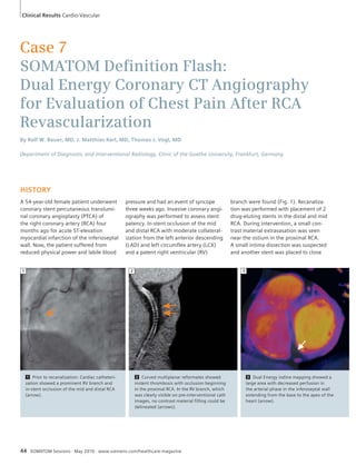 Clinical Results Cardio-Vascular 
Case 7 
SOMATOM Defi nition Flash: 
Dual Energy Coronary CT Angiography 
for Evaluation of Chest Pain After RCA 
Revascularization 
By Ralf W. Bauer, MD, J. Matthias Kerl, MD, Thomas J. Vogl, MD 
Department of Diagnostic and Interventional Radiology, Clinic of the Goethe University, Frankfurt, Germany 
HISTORY 
A 54-year-old female patient underwent 
coronary stent percutaneous translumi-nal 
coronary angioplasty (PTCA) of 
the right coronary artery (RCA) four 
months ago for acute ST-elevation 
myocardial infarction of the inferioseptal 
wall. Now, the patient suffered from 
reduced physical power and labile blood 
pressure and had an event of syncope 
three weeks ago. Invasive coronary angi-ography 
was performed to assess stent 
patency. In-stent occlusion of the mid 
and distal RCA with moderate collateral-ization 
from the left anterior descending 
(LAD) and left circumflex artery (LCX) 
and a patent right ventricular (RV) 
branch were found (Fig. 1). Recanaliza-tion 
was performed with placement of 2 
drug-eluting stents in the distal and mid 
RCA. During intervention, a small con-trast 
material extravasation was seen 
near the ostium in the proximal RCA. 
A small intima dissection was suspected 
and another stent was placed to close 
1 Prior to recanalization: Cardiac catheteri-zation 
showed a prominent RV branch and 
in-stent occlusion of the mid and distal RCA 
(arrow). 
1 
2 Curved multiplanar reformates showed 
instent thrombosis with occlusion beginning 
in the proximal RCA. In the RV branch, which 
was clearly visible on pre-interventional cath 
images, no contrast material filling could be 
delineated (arrows). 
44 SOMATOM Sessions · May 2010 · www.siemens.com/healthcare-magazine 
3 Dual Energy iodine mapping showed a 
large area with decreased perfusion in 
the arterial phase in the inferoseptal wall 
extending from the base to the apex of the 
heart (arrow). 
2 3 
 