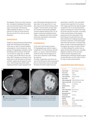 Cardio-Vascular Clinical Results 
EXAMINATION PROTOCOL 
Scanner SOMATOM Definition Flash 
Scan mode Dual Energy 
Scan area Heart 
Scan length 170 mm 
Scan direction Cranio-caudal 
Scan time 4.8 s 
Tube voltage A/B 100 kV/140 kV+Sn filter 
Tube current A/B 165 mAs/140 mAs 
CTDIvol 13.29 mGy 
Rotation time 0.28 s 
Pitch 0.17 
Slice collimation 64 x 0.6 mm 
Slice width 0.75 mm 
Reconstruction 
increment 0.4 mm 
Reconstruction 
kernel D26f 
Volume 70 ml contrast media 
Flow rate 5 ml/s 
Start delay Test bolus 
Post processing syngo Dual Energy 
SOMATOM Sessions · May 2010 · www.siemens.com/healthcare-magazine 45 
the leakage. Three hours after interven-tion, 
the patient developed chest tight-ness 
and retrosternal pain. ECG showed 
signs of the known old infarction 
inferiorseptally (Q waves in II, III and 
aVF) but no signs of acute ischemia. 
She was sent to CT to rule out aortic 
dissection. 
DIAGNOSIS 
Cardiac CT was performed in Dual Energy 
mode with retrospective ECG-gating. 
There was no sign of contrast material 
extravasation or aortic dissection. Dual 
Energy CT Angiography revealed in-stent 
thrombosis with occlusion of the RCA 
13 mm after its origin (Fig. 2). While 
on cardiac cath the RV branch was still 
open, DECT showed an occlusion of the 
vessel due to the thrombus in the proxi-mal 
RCA, explaining the patient’s symp-toms. 
Dual Energy myocardial iodine 
mapping showed a large hypoperfused 
area inferoseptal extending from the 
base down to the apex (Fig. 3). Low 
dose step-and-shoot late enhancement 
images 7 minutes after contrast injec-tion 
showed corresponding delayed 
contrast material washout (Fig. 4). On 
regular anatomical multiplanar refor-mates, 
a moderate thinning of the left 
ventricular myocardium was present 
in that area (Fig. 5). 
COMMENTS 
In this case, Dual Energy coronary 
CT Angiography was used to image a 
complication of interventional recanali-zation, 
i.e. acute in-stent thrombosis, 
while the initial clinical diagnosis of 
acute aortic dissection could reliably 
be ruled out. 
A further complication was the occlu-sion 
of the RV branch (which was patent 
prior to intervention) due to the large 
thrombus formation beginning very 
proximally in the RCA. The new hybrid 
reconstruction algorithm for coronary 
CTA images preserves the high temporal 
resolution of 75 ms of the Dual Source 
system and allows for motion-free imag-ing 
of the vascular structures. According 
to the clinical history of the patient, 
assessment of the myocardium with 
Dual Energy first-pass perfusion and 
late enhancement imaging showed signs 
of chronic infarction in the inferoseptal 
wall of the left ventricle. Increased tube 
power as well as improved separation of 
the spectra by using a tin filter (140 kV 
+ Sn filter) allowed for artifact-free im-aging 
of myocardial perfusion. Complete 
diagnostic work-up of the coronary 
arteries and the myocardium was 
achieved with a total dose length product 
of only 294 mGy cm (227 mGy cm CTA + 
67 mGy cm late enhancement). 
4 Late enhancement was present in the in-feroseptal 
wall corresponding to the perfusion 
defect in arterial phase. 
4 
5 Regular anatomical multiplanar reformates 
showed moderate thinning of the interoseptal 
wall consistent with chronic ischemia (arrow). 
5 
 