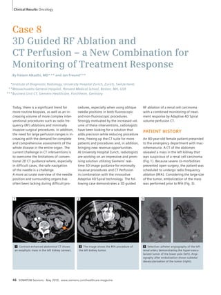 Clinical Results Oncology 
Case 8 
3D Guided RF Ablation and 
CT Perfusion – a New Combination for 
Monitoring of Treatment Response 
By Hatem Alkadhi, MD*,** and Jan Freund*** 
Institute of Diagnostic Radiology, University Hospital Zurich, Zurich, Switzerland; 
Massachusetts General Hospital, Harvard Medical School, Boston, MA, USA 
Business Unit CT, Siemens Healthcare, Forchheim, Germany 
Today, there is a significant trend for 
more routine biopsies, as well as an in-creasing 
volume of more complex inter-ventional 
procedures such as radio fre-quency 
(RF) ablations and minimally 
invasive surgical procedures. In addition, 
the need for large perfusion ranges is in-creasing 
with the demand for complete 
and comprehensive assessments of the 
whole disease in the entire organ. The 
current challenge in CT interventions is 
to overcome the limitations of conven-tional 
2D CT guidance where, especially 
in difficult cases, the safe navigation 
of the needle is a challenge. 
A more accurate overview of the needle 
position and surrounding organs has 
often been lacking during difficult pro-cedures, 
especially when using oblique 
needle positions in both fluoroscopic 
and non-fluoroscopic procedures. 
Strongly motivated by the increased vol-ume 
of these interventions, radiologists 
have been looking for a solution that 
adds precision while reducing procedure 
time, freeing up the CT suite for more 
patients and procedures and, in addition, 
bringing new revenue opportunities. 
At University Hospital Zurich, radiologists 
are working on an impressive and prom-ising 
solution utilizing Siemens’ real-time 
3D image guidance for minimally 
invasive procedures and CT Perfusion 
in combination with the innovative 
Adaptive 4D Spiral technology. The fol-lowing 
case demonstrates a 3D guided 
RF ablation of a renal cell carcinoma 
with a combined monitoring of treat-ment 
response by Adaptive 4D Spiral 
volume perfusion CT. 
PATIENT HISTORY 
An 80-year-old female patient presented 
to the emergency department with mac-rohematuria. 
A CT of the abdomen 
revealed a mass in the left kidney that 
was suspicious of a renal cell carcinoma 
(Fig. 1). Because severe co-morbidities 
prevented open surgery, the patient was 
scheduled to undergo radio frequency 
ablation (RFA). Considering the large size 
of the tumor, embolization of the mass 
was performed prior to RFA (Fig. 3). 
2 
2 The image shows the RFA procedure of 
the left kidney tumor. 
1 
46 SOMATOM Sessions · May 2010 · www.siemens.com/healthcare-magazine 
3 
3 Selective catheter angiography of the left 
renal artery demonstrating the hyper-vascu-larized 
tumor of the lower pole (left). Angi-ography 
after embolization shows subtotal 
devascularization of the tumor (right). 
1 Contrast-enhanced abdominal CT shows 
an exophytic mass in the left kidney (arrow). 
* 
** 
*** 
 