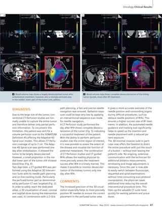 Oncology Clinical Results 
5 
SOMATOM Sessions · May 2010 · www.siemens.com/healthcare-magazine 47 
DIAGNOSIS 
Due to the large size of the tumor, con-ventional 
CT Perfusion studies are nor-mally 
unable to capture the entire tumor 
and therefore deliver only partial perfu-sion 
information. To circumvent this 
limitation, the patient was sent for a 
volume perfusion scan to the SOMATOM 
Definition AS offering the Adaptive 4D 
Spiral scan modes. This allows CT Perfu-sion 
coverage of up to 7 cm. The Adap-tive 
4D Spiral scan was performed one 
day after embolization. It showed the 
tumor to be largely devascularized. 
However, a small proportion in the me-dial 
lower part of the tumor still showed 
blood flow (Fig. 4). 
Two days later, a CT-guided RFA was per-formed 
using the Adaptive 3D Interven-tion 
Suite with its needle path planning 
and on-line tracking mode. Particularly 
the perfused tumor part as demonstrat-ed 
by perfusion CT was targeted (Fig. 2). 
In order to safely reach the dedicated 
areas, a 3D visualization of axial, coronal 
and sagittal slices during the intervention 
was used. In combination with a 2-click 
path planning, a fast and precise needle 
navigation was ensured. Radiation expo-sure 
could be kept very low by applying 
an interventional sequence scan mode 
for needle navigation. 
A CT Perfusion study performed the 
day after RFA shows complete devascu-larization 
of the tumor (Fig. 5) indicating 
a successful treatment of the patient. 
With the ability to perform perfusion 
studies over the entire region of interest, 
it is now possible to assess the extent of 
the disease and visualize the function of 
potential metastases. The combination 
of CT Perfusion studies and CT guided 
RFAs allows the reading physician to 
more precisely assess the treatment 
success after RFA in a timely manner. This 
makes it possible to monitor devascular-ization 
of the kidney tumors only one 
day after RFA. 
COMMENTS 
The increased precision of the 3D visual-ization 
especially helps to more precisely 
position RF needles to ensure the correct 
placement in the perfused tumor area. 
It gives a more accurate overview of the 
needle position and surrounding organs 
during difficult procedures, such as 
oblique needle positions of RFAs. This 
ensures a higher success rate of RF treat-ments. 
In addition, the automated needle 
guidance and tracking tool significantly 
helps to speed up the insertion and 
needle placement with a reduced pa-tient 
exposure. 
The 3D minimal invasive suite in parti-cular 
now offers the freedom to direct 
the entire procedure with just the touch 
of a button – without ever leaving the 
patient’s side. No ongoing, extensive 
communication with the technician for 
additional distance measurements, 
windowing and image adjustments is 
necessary. Since the user is now able 
to easily switch between fluoroscopic, 
sequential and spiral examinations 
without time-consuming scan protocol 
manipulation, the physician saves 
additional time reducing the overall 
interventional procedure time. This 
frees up the valuable CT suite more 
quickly for waiting patients and proce-dures. 
4 Blood volume map shows a largely devascularized tumor after 
embolization treatment, however, also a strongly perfused area 
in the medial, lower part of the tumor (red, yellow). 
4 
5 Blood volume map shows complete devascularization of the kidney 
tumor (purple, blue) after RF treatment. 
 