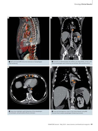 Oncology Clinical Results 
SOMATOM Sessions · May 2010 · www.siemens.com/healthcare-magazine 49 
1 
2 Coronal cut demonstrates the solitary cyst (left kidney, arrow), and 
distal oesophageal wall thickening (arrowhead, IRIS reconstruction). 
2 
3 Axial slice highlights wall thickening of the oesophagus 
(arrowhead), and pericardial effusion (arrows). 
3 
4 Low and homogenous noise in the entire dataset using IRIS 
(coronal slice) reveals oesophageal thickening (arrows). 
4 
1 VRT and fused MPR show the extension of oesophageal 
wall thickening. 
 