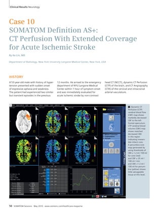 Clinical Results Neurology 
Case 10 
SOMATOM Defi nition AS+: 
CT Perfusion With Extended Coverage 
for Acute Ischemic Stroke 
By Ke Lin, MD 
Department of Radiology, New York University Langone Medical Center, New York, USA 
HISTORY 
A 53-year-old male with history of hyper-tension 
presented with sudden onset 
of expressive aphasia and weakness. 
The patient had experienced two similar 
but transient episodes in the previous 
12 months. He arrived to the emergency 
department of NYU Langone Medical 
Center within 1 hour of symptom onset 
and was immediately evaluated for 
acute ischemic stroke by non-contrast 
50 SOMATOM Sessions · May 2010 · www.siemens.com/healthcare-magazine 
head CT (NCCT), dynamic CT Perfusion 
(CTP) of the brain, and CT Angiography 
(CTA) of the cervical and intracranial 
arterial vasculature. 
1 
1 Dynamic CT 
Perfusion (CTP) 
cerebral blood flow 
(CBF) map shows 
markedly decreased 
CBF to the left 
frontal operculum. 
CTP cerebral blood 
volume (CBV) map 
shows matched 
decreased CBV 
in this region 
indicating irrevers-ible 
infarct core. 
A penumbra-core 
map generated by 
using thresholds of 
CBV ≤ 1.2 ml / 100 ml 
for core (red) 
and CBF ≤ 35 ml / 
100 ml / min 
and CBV >1.2 ml / 
100 ml for penum-bra 
(yellow) shows 
little salvageable 
tissue at this level. 
 