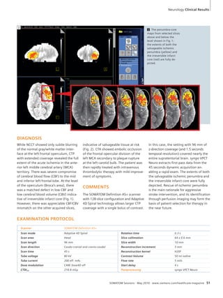 Neurology Clinical Results 
2 The penumbra-core 
maps from selected slices 
above and below the 
level shown in Fig. 1: 
the extents of both the 
salvageable ischemic 
penumbra (yellow) and 
the irreversible infarct 
core (red) are fully de-picted. 
indicative of salvageable tissue at risk 
(Fig. 2). CTA showed embolic occlusion 
of the frontal opercular division of the 
left MCA secondary to plaque rupture 
at the left carotid bulb. The patient was 
then rapidly treated with intravenous 
thrombolytic therapy with mild improve-ment 
of symptoms. 
COMMENTS 
The SOMATOM Definition AS+ scanner 
with 128-slice configuration and Adaptive 
4D Spiral technology allows larger CTP 
coverage with a single bolus of contrast. 
In this case, the setting with 96 mm of 
z-direction coverage (and 1.5 seconds 
temporal resolution) covered nearly the 
entire supratentorial brain. syngo VPCT 
Neuro extracts first-pass data from the 
45 seconds dynamic acquisition en-abling 
a rapid exam. The extents of both 
the salvageable ischemic penumbra and 
the irreversible infarct core were fully 
depicted. Rescue of ischemic penumbra 
is the main rationale for aggressive 
stroke intervention, and its identification 
through perfusion imaging may form the 
basis of patient selection for therapy in 
the near future. 
SOMATOM Sessions · May 2010 · www.siemens.com/healthcare-magazine 51 
DIAGNOSIS 
While NCCT showed only subtle blurring 
of the normal gray/white matter inter-face 
at the left frontal operculum, CTP 
with extended coverage revealed the full 
extent of the acute ischemia in the ante-rior 
left middle cerebral artery (MCA) 
territory. There was severe compromise 
of cerebral blood flow (CBF) to the mid 
and inferior left frontal lobe. At the level 
of the operculum (Broca’s area), there 
was a matched defect in low CBF and 
low cerebral blood volume (CBV) indica-tive 
of irreversible infarct core (Fig. 1). 
However, there was appreciable CBF/CBV 
mismatch on the other acquired slices, 
EXAMINATION PROTOCOL 
Scanner SOMATOM Definition AS+ 
Scan mode Adaptive 4D Spiral Rotation time 0.3 s 
Scan area Head Slice collimation 64 x 0.6 mm 
Scan length 96 mm Slice width 10 mm 
Scan direction Caudo-cranial and cranio-caudal Reconstruction increment 5 mm 
Scan time 45 s Reconstruction kernel H20f 
Tube voltage 80 kV Contrast Volume 50 ml iodine 
Tube current 200 eff. mAs Flow rate 5 ml/s 
Dose modulation CARE Dose4D off Start delay 4 s 
CTDIvol 218.8 mGy Postprocessing syngo VPCT Neuro 
2 
 