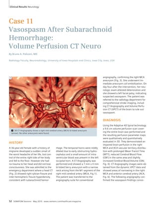 Clinical Results Neurology 
Case 11 
Vasospasm After Subarachnoid 
Hemorrhage: 
Volume Perfusion CT Neuro 
By Bruno A. Policeni, MD 
Radiology Faculty, Neuroradiology, University of Iowa Hospitals and Clinics, Iowa City, Iowa, USA 
1 3D CT Angiography shows a right mid cerebral artery (MCA) bi-lobed aneurysm 
(arrow). No other aneurysms were found. 
HISTORY 
A 36-year-old female with a history of 
migraine developed a sudden onset of 
the worst headache of her life, lost con-trol 
of the entire right side of her body 
and fell to the floor. However she had 
no trauma to her head and did not lose 
consciousness. She was admitted to the 
emergency department where a head CT 
(Fig. 2) showed right sylvian fissure and 
inter-hemispheric fissure hyperdensity 
consistent with subarachnoid hemor- 
rhage. The temporal horns were mildly 
dilated due to early obstructing hydro-cephalus 
and a small amount of intra-ventricular 
blood was present in the left 
occipital horn. A CT Angiography was 
performed and showed a 7 mm x 4 mm 
bi-lobed berry aneurysm with a narrow 
neck arising from the M1 segment of the 
right mid cerebral artery (MCA, Fig.1). 
The patient was transferred to the 
angiography suite for conventional 
52 SOMATOM Sessions · May 2010 · www.siemens.com/healthcare-magazine 
angiography, confirming the right MCA 
aneurysm (Fig. 3). She underwent im-mediate 
aneurysm coil embolization. On 
day four after the intervention, her neu-rologic 
exam attested deterioration and 
she showed a left facial palsy, indicating 
suspected vasospasm. The patient was 
referred to the radiology department for 
comprehensive stroke imaging, includ-ing 
CT Angiography and Volume Perfu-sion 
CT (VPCT) of the brain to rule out 
vasospasm. 
DIAGNOSIS 
Using the Adaptive 4D Spiral technology 
a 9.6 cm volume perfusion scan cover-ing 
the entire brain was performed and 
the resulting perfusion parameter maps 
were qualitatively and quantitatively 
evaluated in 3D. They demonstrated an 
impaired brain perfusion in the right 
MCA and ACA vascular territory distribu-tion 
with prolonged Mean Transit Time 
(MTT), reduced Cerebral Blood Flow 
(CBF) in the same area and slightly 
increased Cerebral Blood Volume (CBV, 
Fig. 4). CT Angiography images were ob-tained 
from the dynamic VPCT data and 
showed areas of narrowing in the right 
MCA and anterior cerebral artery (ACA, 
Fig. 6). The following angiography con-firmed 
the vasospasm findings consis- 
1 
L R 
 