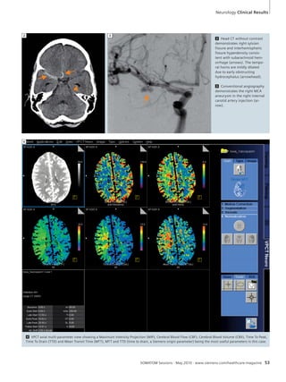 3 Conventional angiography 
demonstrates the right MCA 
aneurysm in the right internal 
carotid artery injection (ar-row). 
SOMATOM Sessions · May 2010 · www.siemens.com/healthcare-magazine 53 
4 
2 Head CT without contrast 
demonstrates right sylvian 
fissure and interhemispheric 
fissure hyperdensity consis-tent 
with subarachnoid hem-orrhage 
(arrows). The tempo-ral 
horns are mildly dilated 
due to early obstructing 
hydrocephalus (arrowhead). 
2 3 
Neurology Clinical Results 
4 VPCT axial multi-parameter view showing a Maximum Intensity Projection (MIP), Cerebral Blood Flow (CBF), Cerebral Blood Volume (CBV), Time To Peak, 
Time To Drain (TTD) and Mean Transit Time (MTT), MTT and TTD (time to drain, a Siemens origin parameter) being the most useful parameters in this case. 
 