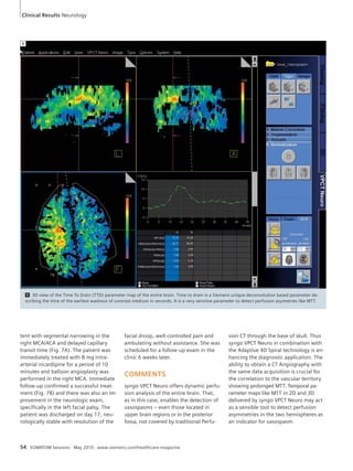 Clinical Results Neurology 
5 3D view of the Time To Drain (TTD) parameter map of the entire brain. Time to drain is a Siemens unique deconvolution based parameter de-scribing 
the time of the earliest washout of contrast medium in seconds. It is a very sensitve parameter to detect perfusion asymetries like MTT. 
tent with segmental narrowing in the 
right MCA/ACA and delayed capillary 
transit time (Fig. 7A). The patient was 
immediately treated with 8 mg intra-arterial 
nicardipine for a period of 10 
minutes and balloon angioplasty was 
performed in the right MCA. Immediate 
follow-up confirmed a successful treat-ment 
(Fig. 7B) and there was also an im-provement 
in the neurologic exam, 
specifically in the left facial palsy. The 
patient was discharged on day 17, neu-rologically 
stable with resolution of the 
facial droop, well-controlled pain and 
ambulating without assistance. She was 
scheduled for a follow-up exam in the 
clinic 6 weeks later. 
COMMENTS 
syngo VPCT Neuro offers dynamic perfu-sion 
analysis of the entire brain. That, 
as in this case, enables the detection of 
vasospasms – even those located in 
upper brain regions or in the posterior 
fossa, not covered by traditional Perfu-sion 
54 SOMATOM Sessions · May 2010 · www.siemens.com/healthcare-magazine 
CT through the base of skull. Thus 
syngo VPCT Neuro in combination with 
the Adaptive 4D Spiral technology is en-hancing 
the diagnostic application. The 
ability to obtain a CT Angiography with 
the same data acquisition is crucial for 
the correlation to the vascular territory 
showing prolonged MTT. Temporal pa-rameter 
maps like MTT in 2D and 3D 
delivered by syngo VPCT Neuro may act 
as a sensible tool to detect perfusion 
asymmetries in the two hemispheres as 
an indicator for vasospasm. 
5 
 