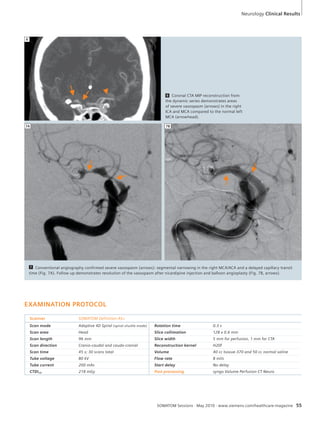 Neurology Clinical Results 
6 Coronal CTA MIP reconstruction from 
the dynamic series demonstrates areas 
of severe vasospasm (arrows) in the right 
ICA and MCA compared to the normal left 
MCA (arrowhead). 
7A 7B 
7 Conventional angiography confirmed severe vasospasm (arrows): segmental narrowing in the right MCA/ACA and a delayed capillary transit 
time (Fig. 7A). Follow up demonstrates resolution of the vasospasm after nicardipine injection and balloon angioplasty (Fig. 7B, arrows). 
SOMATOM Sessions · May 2010 · www.siemens.com/healthcare-magazine 55 
EXAMINATION PROTOCOL 
Scanner SOMATOM Definition AS+ 
Scan mode Adaptive 4D Spiral (spiral shuttle mode) Rotation time 0.3 s 
Scan area Head Slice collimation 128 x 0.6 mm 
Scan length 96 mm Slice width 5 mm for perfusion, 1 mm for CTA 
Scan direction Cranio-caudal and caudo-cranial Reconstruction kernel H20f 
Scan time 45 s; 30 scans total Volume 40 cc Isovue-370 and 50 cc normal saline 
Tube voltage 80 kV Flow rate 8 ml/s 
Tube current 200 mAs Start delay No delay 
CTDIvol 218 mGy Post processing syngo Volume Perfusion CT Neuro 
6 
 