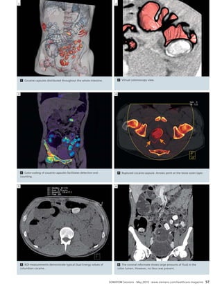 4 Ruptured cocaine capsule. Arrows point at the loose outer layer. 
2 
SOMATOM Sessions · May 2010 · www.siemens.com/healthcare-magazine 57 
1 Cocaine capsules distributed throughout the whole intestine. 
3 Color-coding of cocaine capsules facilitates detection and 
counting. 
5 ROI measurements demonstrate typical Dual Energy values of 
columbian cocaine. 
1 
3 
5 
Neuroradiology Clinical Results 
2 Virtual colonoscopy view. 
6 The coronal reformate shows large amounts of fluid in the 
colon lumen. However, no ileus was present. 
4 
6 
 