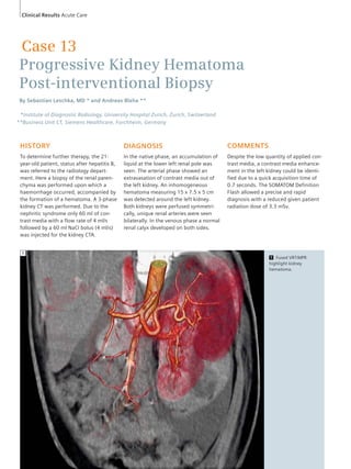 Clinical Results Acute Care 
Case 13 
Progressive Kidney Hematoma 
Post-interventional Biopsy 
By Sebastian Leschka, MD * and Andreas Blaha ** 
*Institute of Diagnostic Radiology, University Hospital Zurich, Zurich, Switzerland 
**Business Unit CT, Siemens Healthcare, Forchheim, Germany 
HISTORY 
To determine further therapy, the 21- 
year-old patient, status after hepatitis B, 
was referred to the radiology depart-ment. 
Here a biopsy of the renal paren-chyma 
was performed upon which a 
haemorrhage occurred, accompanied by 
the formation of a hematoma. A 3-phase 
kidney CT was performed. Due to the 
nephritic syndrome only 60 ml of con-trast 
media with a flow rate of 4 ml/s 
followed by a 60 ml NaCl bolus (4 ml/s) 
was injected for the kidney CTA. 
1 Fused VRT/MPR 
highlight kidney 
hematoma. 
DIAGNOSIS 
In the native phase, an accumulation of 
liquid at the lower left renal pole was 
seen. The arterial phase showed an 
extravasation of contrast media out of 
the left kidney. An inhomogeneous 
hematoma measuring 15 x 7.5 x 5 cm 
was detected around the left kidney. 
Both kidneys were perfused symmetri-cally, 
unique renal arteries were seen 
bilaterally. In the venous phase a normal 
renal calyx developed on both sides. 
COMMENTS 
Despite the low quantity of applied con-trast 
media, a contrast media enhance-ment 
in the left kidney could be identi-fied 
due to a quick acquisition time of 
0.7 seconds. The SOMATOM Definition 
Flash allowed a precise and rapid 
diagnosis with a reduced given patient 
radiation dose of 3.3 mSv. 
1 
 