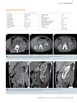 Acute Care Clinical Results 
2C 
3C 
SOMATOM Sessions · May 2010 · www.siemens.com/healthcare-magazine 59 
EXAMINATION PROTOCOL 
Scanner SOMATOM Definition Flash 
Scan mode 3-phase kidney Rotation time 0.28 s 
Scan area Abdomen Pitch 2.1 
Scan length 218 mm Slice collimation 128 x 0.6 mm 
Scan direction Cranio-caudal Slice width 2 mm 
Scan time 0.7 s Reconstruction increment 1 mm 
Tube voltage 120 kV / 120 kV Reconstruction kernel B30f 
Tube current 100 eff. mAs Contrast Volume 60 ml Iodine 
Dose modulation CARE Dose4D Flow rate 4 ml/s 
CTDIvol 7.71 mGy Postprocessing syngo CT 3D 
syngo InSpace 
2A 2B 
2 Axial non-enhancement multiplanar reformation (MPR, Fig. 2A); axial early enhancement MPR shows haemorrhages in the 
kidney hematoma (arrow, Fig. 2B). Axial late state MPR shows persistent bleeding (arrow, Fig. 2C). 
3B 
3A 
3 Sagittal non-enhancement MPR (Fig. 3A); sagittal early enhancement MPR shows hemorrhages in the kidney hematoma 
(arrow, Fig. 3B); sagittal late state MPR shows persistent bleeding (arrow, Fig. 3C). 
 