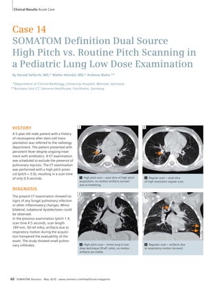 Clinical Results Acute Care 
Case 14 
SOMATOM Defi nition Dual Source 
High Pitch vs. Routine Pitch Scanning in 
a Pediatric Lung Low Dose Examination 
By Harald Seifarth, MD,* Walter Heindel, MD,* Andreas Blaha ** 
*Department of Clinical Radiology, University Hospital, Münster, Germany 
**Business Unit CT, Siemens Healthcare, Forchheim, Germany 
HISTORY 
A 5-year-old male patient with a history 
of neutropenia after stem-cell trans-plantation 
was referred to the radiology 
department. The patient presented with 
persistent fever despite ongoing treat-ment 
with antibiotics. A CT examination 
was scheduled to exclude the presence of 
pulmonary mycosis. The CT examination 
was performed with a high pitch proto-col 
(pitch = 3.0), resulting in a scan time 
of only 0.9 seconds. 
DIAGNOSIS 
The present CT examination showed no 
signs of any fungal pulmonary infection 
or other inflammatory changes. Minor 
bilateral, subpleural dystelectases could 
be observed. 
In the previous examination (pitch 1.4, 
scan time 4.5 seconds, scan length 
189 mm, 50 ref mAs), artifacts due to 
respiratory motion during the acquisi-tion 
hampered the evaluability of the 
exam. The study showed small pulmo-nary 
infiltrates. 
1 2 
3 
60 SOMATOM Sessions · May 2010 · www.siemens.com/healthcare-magazine 
2 Regular scan – axial slice 
of high resolution regular scan. 
1 High pitch scan – axial slice of high pitch 
acquisition, no motion artifacts (arrow) 
due to breathing. 
3 High pitch scan – entire lung in low 
dose technique (10 eff. mAs), no motion 
artifacts are visible. 
4 
4 Regulars scan – artifacts due 
to respiratory motion (arrows). 
 