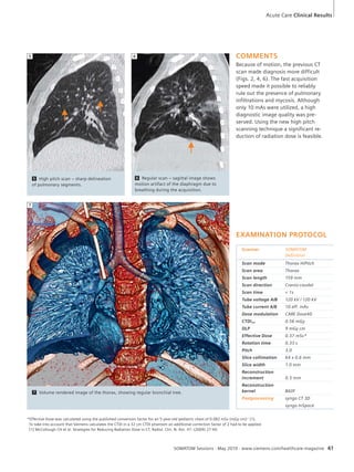Acute Care Clinical Results 
5 6 COMMENTS 
EXAMINATION PROTOCOL 
Scanner SOMATOM 
Definition 
Scan mode Thorax HiPitch 
Scan area Thorax 
Scan length 159 mm 
Scan direction Cranio-caudal 
Scan time < 1s 
Tube voltage A/B 120 kV / 120 kV 
Tube current A/B 10 eff. mAs 
Dose modulation CARE Dose4D 
CTDIvol 0.56 mGy 
DLP 9 mGy cm 
Effective Dose 0.37 mSv* 
Rotation time 0.33 s 
Pitch 3.0 
Slice collimation 64 x 0.6 mm 
Slice width 1.0 mm 
Reconstruction 
increment 0.5 mm 
Reconstruction 
kernel B60f 
Postprocessing syngo CT 3D 
syngo InSpace 
7 Volume rendered image of the thorax, showing regular bronchial tree. 
SOMATOM Sessions · May 2010 · www.siemens.com/healthcare-magazine 61 
7 
6 Regular scan – sagittal image shows 
motion artifact of the diaphragm due to 
breathing during the acquisition. 
5 High pitch scan – sharp delineation 
of pulmonary segments. 
Because of motion, the previous CT 
scan made diagnosis more difficult 
(Figs. 2, 4, 6). The fast acquisition 
speed made it possible to reliably 
rule out the presence of pulmonary 
infiltrations and mycosis. Although 
only 10 mAs were utilized, a high 
diagnostic image quality was pre-served. 
Using the new high pitch 
scanning technique a significant re-duction 
of radiation dose is feasible. 
*Effective Dose was calculated using the published conversion factor for an 5-year-old pediatric chest of 0.082 mSv (mGy cm)-1 [1]. 
To take into account that Siemens calculates the CTDI in a 32 cm CTDI phantom an additional correction factor of 2 had to be applied. 
[1] McCollough CH et al. Strategies for Reducing Radiation Dose in CT, Radiol. Clin. N. Am. 47: (2009) 27-40. 
 