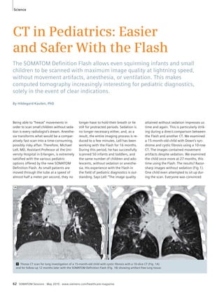 Science 
CT in Pediatrics: Easier 
and Safer With the Flash 
The SOMATOM Defi nition Flash allows even squirming infants and small 
children to be scanned with maximum image quality at lightning speed, 
without movement artifacts, anesthesia, or ventilation. This makes 
computed tomography increasingly interesting for pediatric diagnostics, 
solely in the event of clear indications. 
By Hildegard Kaulen, PhD 
Being able to “freeze” movements in 
order to scan small children without seda-tion 
is every radiologist’s dream. Anesthe-sia 
transforms what would be a compar-atively 
fast scan into a time-consuming, 
possibly risky affair. Therefore, Michael 
Lell, MD, Assistant Professor at the Uni-versity 
Hospital in Erlangen, is extremely 
satisfied with the various pediatric 
options offered by the new SOMATOM 
Definition Flash. As small patients are 
moved through the tube at a speed of 
almost half a meter per second, they no 
longer have to hold their breath or lie 
still for protracted periods. Sedation is 
no longer necessary either, and, as a 
result, the entire imaging process is re-duced 
to a few minutes. Lell has been 
working with the Flash for 16 months. 
During this period, he has successfully 
scanned 50 infants and toddlers, and 
the same number of children and ado-lescents, 
without sedation or anesthe-sia. 
His experience with the Flash in 
the field of pediatric diagnostics is out-standing. 
Says Lell: “The image quality 
1A 1B 
62 SOMATOM Sessions · May 2010 · www.siemens.com/healthcare-magazine 
attained without sedation impresses us 
time and again. This is particularly strik-ing 
during a direct comparison between 
the Flash and another CT. We examined 
a 15-month-old child with Down’s syn-drome 
and cystic fibrosis using a 10-row 
CT. The images contained movement 
artifacts despite sedation. We examined 
the child once more at 27 months, this 
time using the Flash. The results? Razor-sharp 
images without sedation (Fig.1). 
One child even attempted to sit up dur-ing 
the scan. Everyone was convinced 
1 Thorax CT scan for lung investigation of a 15-month-old child with cystic fibrosis with a 10-slice CT (Fig. 1A) 
and for follow-up 12 months later with the SOMATOM Definition Flash (Fig. 1B) showing artifact-free lung tissue. 
 