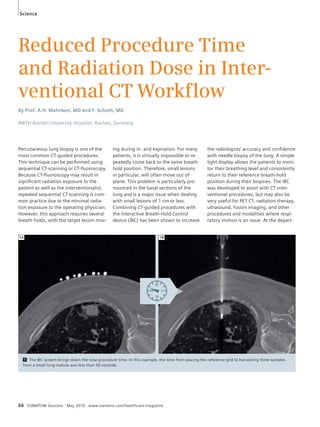 Science 
Reduced Procedure Time 
and Radiation Dose in Inter-ventional 
CT Workflow 
By Prof. A.H. Mahnken, MD and F. Schoth, MD 
RWTH Aachen University Hospital, Aachen, Germany 
Percutaneous lung biopsy is one of the 
most common CT-guided procedures. 
This technique can be performed using 
sequential CT-scanning or CT-fluoroscopy. 
Because CT-fluoroscopy may result in 
significant radiation exposure to the 
patient as well as the interventionalist, 
repeated sequential CT-scanning is com-mon 
practice due to the minimal radia-tion 
exposure to the operating physician. 
However, this approach requires several 
breath holds, with the target lesion mov-ing 
during in- and expiration. For many 
patients, it is virtually impossible to re-peatedly 
come back to the same breath 
hold position. Therefore, small lesions 
in particular, will often move out of 
plane. This problem is particularly pro-nounced 
in the basal sections of the 
lung and is a major issue when dealing 
with small lesions of 1 cm or less. 
Combining CT-guided procedures with 
the Interactive Breath-Hold Control 
device (IBC) has been shown to increase 
1A 1B 
45 
60 
15 
30 
66 SOMATOM Sessions · May 2010 · www.siemens.com/healthcare-magazine 
the radiologists’ accuracy and confidence 
with needle biopsy of the lung. A simple 
light display allows the patients to moni-tor 
their breathing level and consistently 
return to their reference breath-hold 
position during their biopsies. The IBC 
was developed to assist with CT inter-ventional 
procedures, but may also be 
very useful for PET CT, radiation therapy, 
ultrasound, fusion imaging, and other 
procedures and modalities where respi-ratory 
motion is an issue. At the depart- 
1 The IBC system brings down the total procedure time. In this example, the time from placing the reference grid to harvesting three samples 
from a small lung nodule was less than 50 seconds. 
 