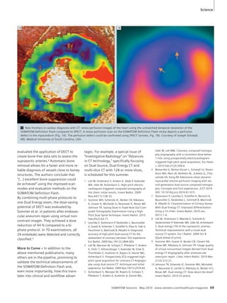 Science 
1 New frontiers in cardiac diagnosis with CT: stress-perfusion images of the heart using the unmatched temporal resolution of the 
SOMATOM Definition Flash compared to SPECT. A stress perfusion scan on the SOMATOM Definition Flash nicely depicts a perfusion 
defect in the myocardium (Fig. 1A). The perfusion defect could be confirmed using SPECT (arrows, Fig. 1B). Courtesy of Joseph Schoepf, 
MD, Medical University of South Carolina, USA. 
tages. For example, a special issue of 
“Investigative Radiology” on “Advances 
in CT technology,” specifically focusing 
on Dual Source, Dual Energy CT and 
multi-slice CT with 128 or more slices, 
is scheduled for this summer. 
SOMATOM Sessions · May 2010 · www.siemens.com/healthcare-magazine 69 
evaluated the application of DECT to 
create bone-free data sets to assess the 
supraaortic arteries.8 Automatic bone 
removal allows for a faster and more re-liable 
diagnosis of vessels close to boney 
structures. The authors conclude that 
“[…] excellent bone suppression could 
be achieved” using the improved scan 
modes and evaluation methods on the 
SOMATOM Definition Flash. 
By combining multi-phase protocols to 
one Dual Energy exam, the dose-saving 
potential of DECT was evaluated by 
Sommer et al. in patients after endovas-cular 
aneurism repair using virtual non-contrast 
images. They achieved a dose 
reduction of 44 % compared to a bi-phase 
protocol. In 70 examinations, all 
24 endoleaks were detected and correctly 
classified.9 
More to Come – In addition to the 
above mentioned publications, many 
others are in the pipeline, promising to 
validate the technical advancements of 
the SOMATOM Definition Flash and, 
even more importantly, how this trans-lates 
into clinical and workflow advan- 
1 Lell M, Hinkmann F, Anders K, Deak P, Kalender 
WA, Uder M, Achenbach S. High-pitch electro-cardiogram- 
triggered computed tomography of 
the chest: initial results, Invest Radiol. 2009 
Nov;44(11):728-33. 
2 Sommer WH, Schenzle JC, Becker CR, Nikolaou 
K, Graser A, Michalski G, Neumaier K, Reiser MF, 
Johnson TR. Saving Dose in Triple-Rule-Out Com-puted 
Tomography Examination Using a High- 
Pitch Dual Spiral Technique. Invest Radiol. 2010 
Feb;45(2):64-71. 
3 Leschka S, Stolzmann P, Desbiolles L, Baumueller 
S, Goetti R, Schertler T, Scheffel H, Plass A, Falk V, 
Feuchtner G, Marincek B, Alkadhi H. Diagnostic 
accuracy of high-pitch dual-source CT for the 
assessment of coronary stenoses: first experience. 
Eur Radiol. 2009 Dec;19(12):2896-903. 
4 Lell M, Marwan M, Schepis T, Pflederer T, Anders 
K, Flohr T, Allmendinger T, Kalender W, Ertel D, 
Thierfelder C, Kuettner A, Ropers D, Daniel WG, 
Achenbach S. Prospectively ECG-triggered high-pitch 
spiral acquisition for coronary CT Angiogra-phy 
using dual source CT: technique and initial 
experience. Eur Radiol. 2009 Nov;19(11):2576-83. 
5 Achenbach S, Marwan M, Ropers D, Schepis T, 
Pflederer T, Anders K, Kuettner A, Daniel WG, 
Uder M, Lell MM. Coronary computed tomogra-phy 
angiography with a consistent dose below 
1 mSv using prospectively electrocardiogram-triggered 
high-pitch spiral acquisition. Eur Heart 
J. 2010 Feb;31(3):340-6. 
6 Bastarrika G, Ramos-Duran L, Schoepf UJ, Rosen-blum 
MA, Abro JA, Brothers RL, Zubieta JL, Chia-ramida 
SA, Kang DK Adenosine-stress dynamic 
myocardial volume perfusion imaging with sec-ond 
generation dual-source computed tomogra-phy: 
Concepts and first experiences. JCCT 2010 
DOI: 10.1016/j.jcct.2010.01.015. 
7 Stolzmann P, Leschka S, Scheffel H, Rentsch K, 
Baumüller S, Desbiolles L, Schmidt B, Marincek 
B, Alkadhi H. Characterization of Urinary Stones 
With Dual-Energy CT: Improved Differentiation 
Using a Tin Filter. Invest Radiol. 2010 Jan; 
45(1):1-6. 
8 Lell M, Hinkmann F, Nkenke E, Schmidt B, 
Seidensticker P, Kalender WA, Uder M, Achenbach 
S. Dual energy CTA of the supraaortic arteries: 
Technical improvements with a novel dual 
source CT system. Eur J Radiol. 2009 Oct 8 
[Epub ahead of print]. 
9 Sommer WH, Graser A, Becker CR, Clevert DA, 
Reiser MF, Nikolaou K, Johnson TR. Image quality 
of virtual noncontrast images derived from dual-energy 
CT Angiography after endovascular 
aneurysm repair. J Vasc Interv Radiol. 2010 Mar; 
21(3):315-21. 
10 Johnson TR, Schenzle JC, Sommer WH, Michalski 
G, Neumaier K, Lechel U, Nikolaou K, Becker H-C, 
Reiser MF. Dual energy CT: How about the dose? 
Invest Radiol. 2010 (in press). 
1A 1B 
 